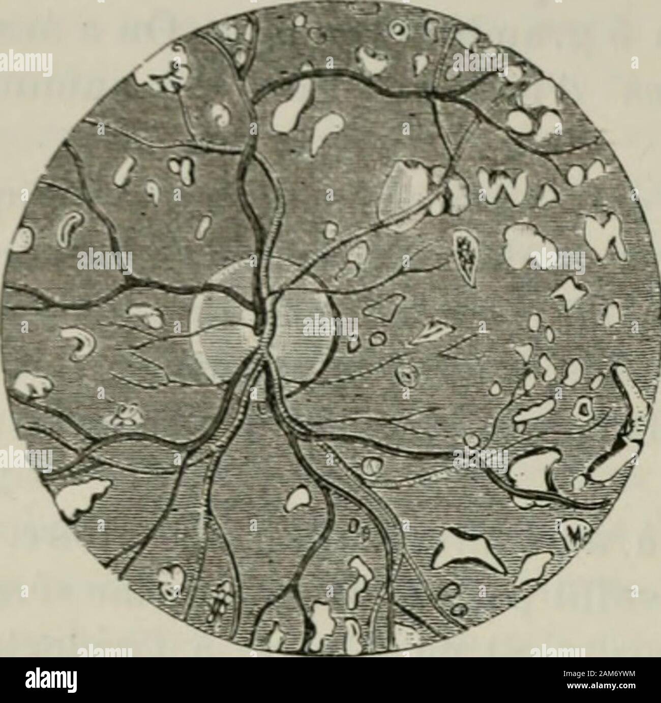 Traité de Chirurgie. ¯ Di:. thritismo paraî t jouer un vCAc dans sa pioducliou. Kuliii. ou la voil parfois sedà © velopper sur les Yeux de alleinls uiyo |> ie aNce slapliylouu posià © rieui -. La choroà ¯ dile. ≪i/j)/iiliti (Ji (c se iiiouli-e à une |) ériode iuleruià © diaire aux acci - Lenis el secondaires aux aeeidenis lerliaiics. De la dit iià Weeker © (puMile dansles Syphilis eontraelà © Es Après-ski quarante ans.cl Vu parlieuliei - chez les officiers. Elle a été observée dans le cas de Syphilis héIÖW © ditaire (llutchinson). Relativement au siè^e, la ehoroà ¯ dite einfache dilTà ¨ i-e de la choroà ¯ dile s Stockfoto