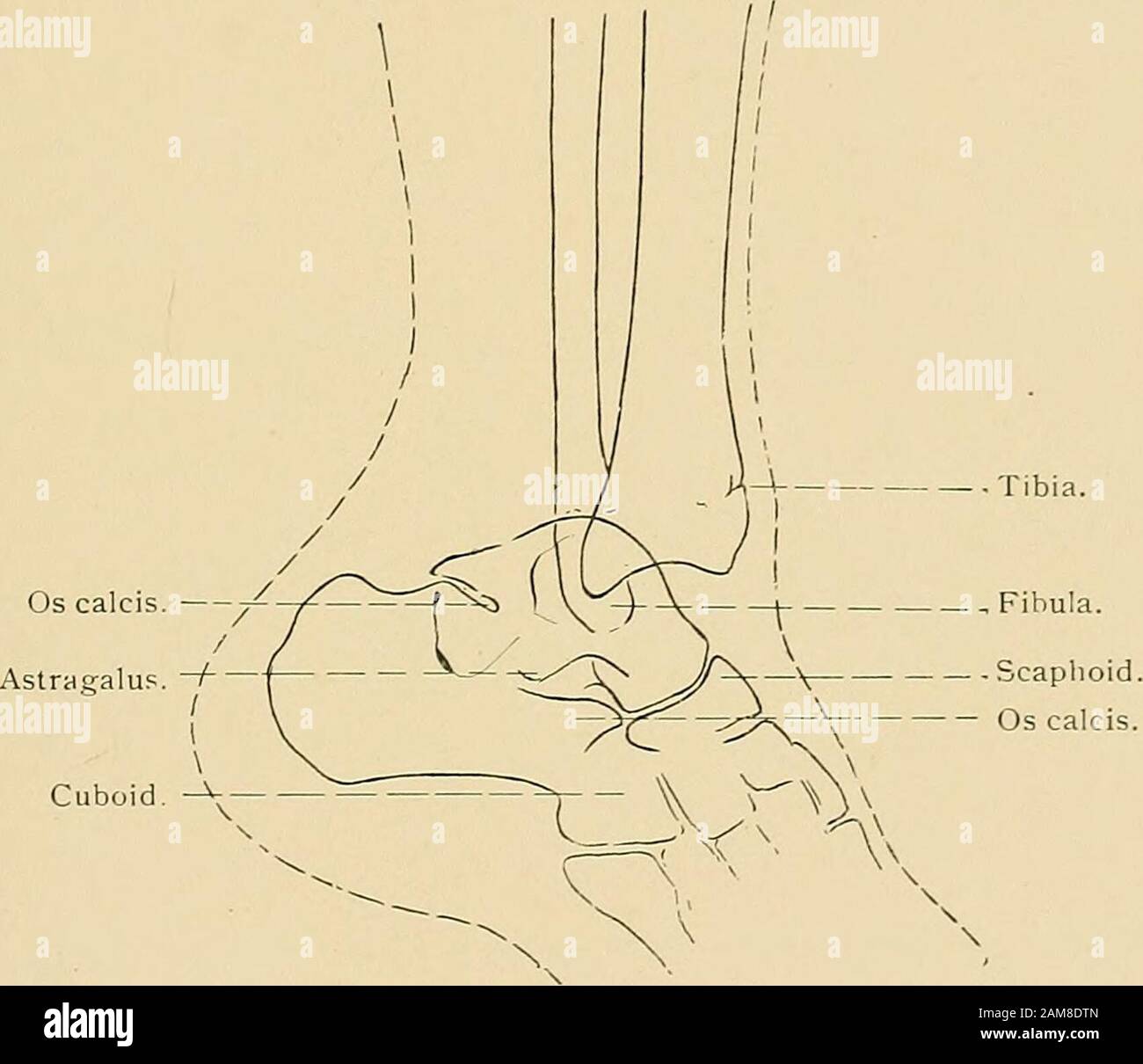 Die Behandlung von Frakturen . entführt, wird das Sieb am inneren lateralen Ligament und am unteren tibio-fibulären interossösen Ligament gefühlt, und diese geben nach. Wenn die Pinzettines beschädigt sind, bricht die Fibel (siehe Abb. 529). Wenn die Kraft stillsteht, wird der innere Mälleolus durch die Haut gedrückt, und es entsteht eine offene Fraktur (siehe Abb. 530). Hält das internallaterale Ligament gegen diese Seitenkraft, kann die Spitze des inneren Malleolus abgezogen werden. Potts FRAKTUR 3Si Symptome.-Der Knöchel zeigt eine sehr konstante Schein-ance nach dieser Fraktur. Eine traumatische Synovitis existiert. Greatsw Stockfoto