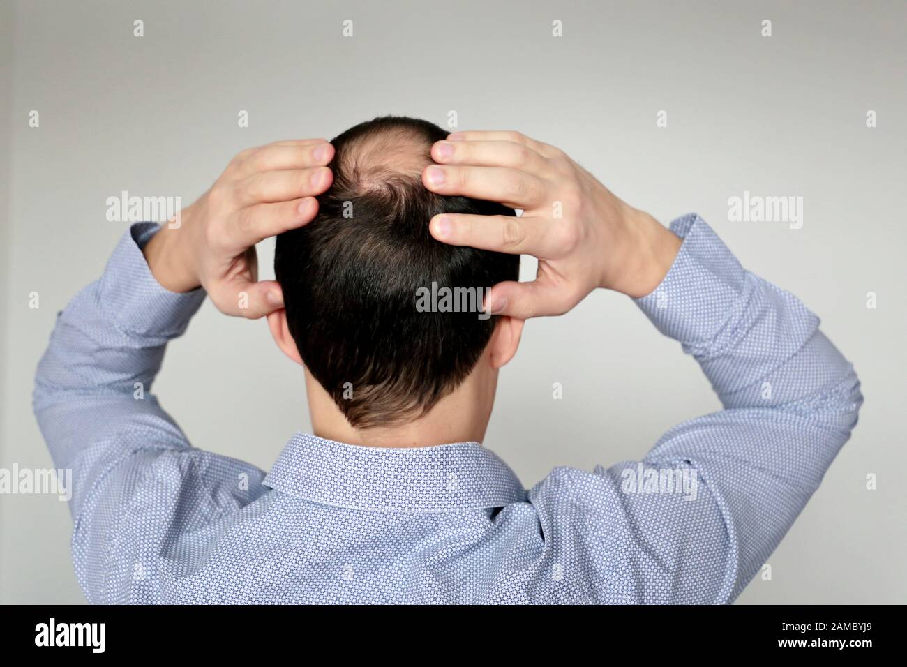 Kahlheit, Mann im Bürotrikot besorgt über Haarausfall. Männerkopf mit kahlem, Konzept von Stress bei der Arbeit Stockfoto