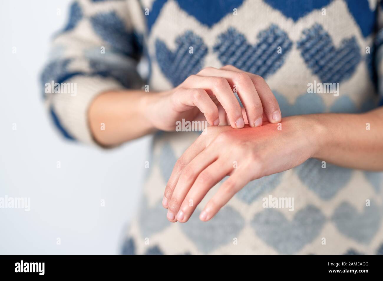 Junge Frau zerkratzt ihre juckende Hand. Konzept Hautproblem, Allergie und Dermatologie Stockfoto