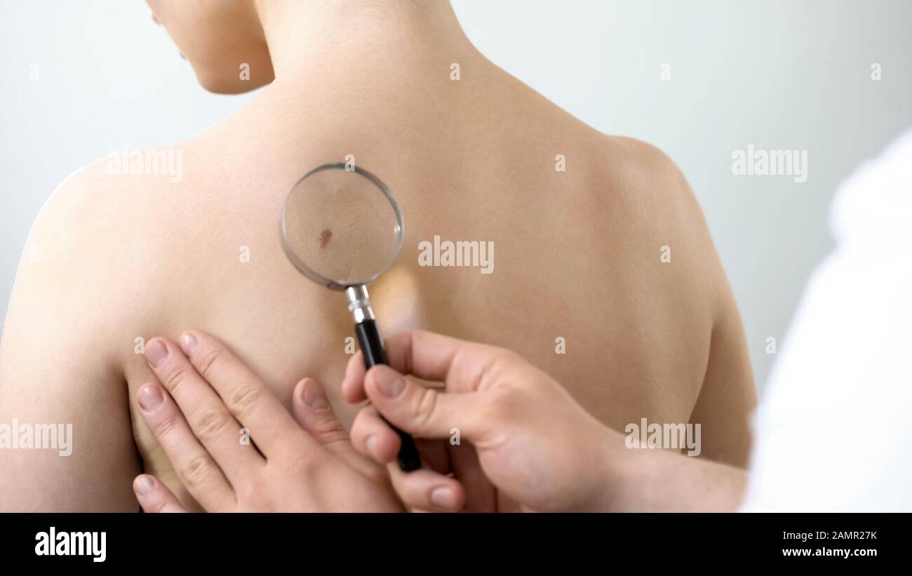 Dermatologe überprüft Maulwurf durch Lupe, Hautkrebsprävention Stockfoto