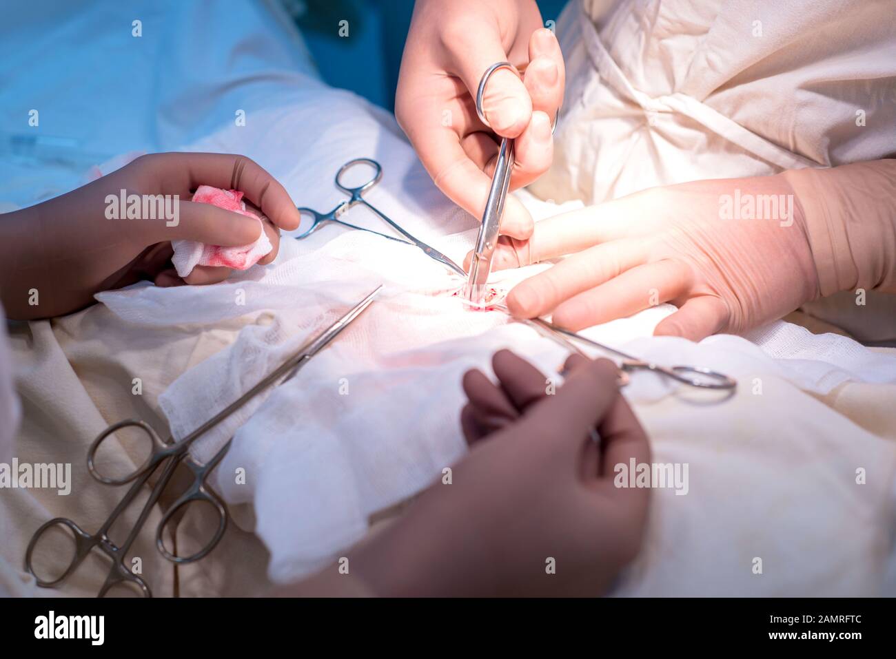 Der Chirurg und sein Assistent arbeiten, die in einem sterilen Op. Nahaufnahme der Hand einer pädiatrischen Chirurg. Phase der Operation für eine Urologische dise Stockfoto