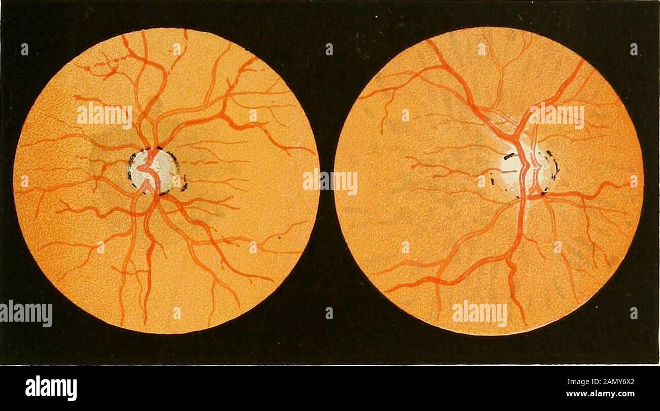 Organische und funktionelle Nervenkrankheiten; ein Textbuch der Neurologie . entwickeln sich sehr bald nach der Geburt aus der tatsächlichen angeborenen Defektiveentwicklung des Sehnervs. In diesen Fällen weisen andere nervöse Symp-Toms normalerweise auf eine unvollkommene Entwicklung des Nervensystems hin, wie zum Beispiel Unbescheidenheit und Idiokie oder spastische Lähmungen. Diese Fälle wurden von Sachs am häufigsten beschrieben.^ Vogts hat beobachtet, dass sich bei Kindern im Alter von acht oder zehn Jahren die gleiche Kondition entwickelt hat. In vielen Kasesprimäroptik Atrophie ist ein Zustand, der mit anderen Krankheiten assoziiert ist, obwohl sie kaum als sekundär bezeichnet werden kann. Das ist n Stockfoto