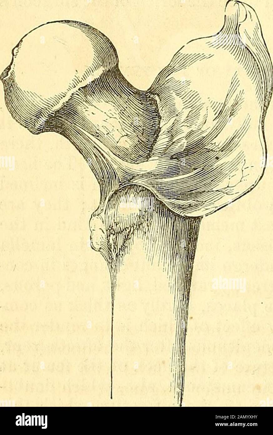 Ein chirurgisches System: Pathologisch, diagnostisch, therapeutisch und operativ. Vorne und bel^ind, von einem Trochanter zum anderen, so dass sowohl der Kopf als auch der Hals des Knochens eingeschlossen sind. Er steigt weiter nach unten auf der vorderen als auf der posterioren Oberfläche des Halses ab und ist dicker und stärker über- und zurückstehend als in jedem anderen Teil von itsweitem. Anteriorly wird es durch die Muskulatur der Depsoen, der Iliakie und der Oberschenkelmuskulatur verstärkt, wobei ein Band aus Ligamentusfasern zusammenkommt; posteriorly, durch die geminale, pyriforme und innere Obturatormuskulatur; intern, durch die pektinale und out-er Obturatormuskulatur; und superio Stockfoto