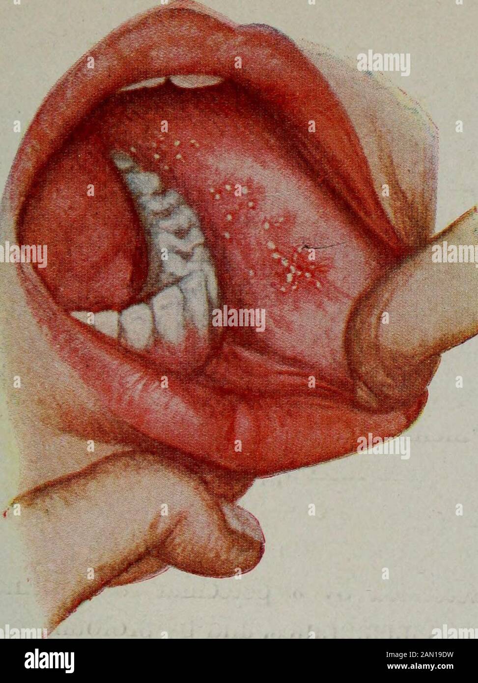 Erkrankungen von Kindern, für Krankenschwestern, einschließlich Säuglingsfütterung, therapeutische Maßnahmen im Kindesalter, Behandlung von Notfällen, Prophylaxe, Hygiene und Krankenpflege. D hygienische Bedingungen und zeichnet sich durch einen Hautausschlag, Blutungen von den Schleimhäuten und eine tiefe Prostration aus. Komplikationen und Fortsetzungserscheinungen - Bei weitem überwiegen die Kapillarbronchitis oder die atarrhalalen Pneumoniaund Otitis Media. Auch Magen-Darm-Störungen, Cancrumoris, Tuberkulose und Lähmungen sind zu beobachten. Prognose.-Positiv. CompHcations scheinen aufzutreten und die Prognose zu gravieren. Die Stockfoto