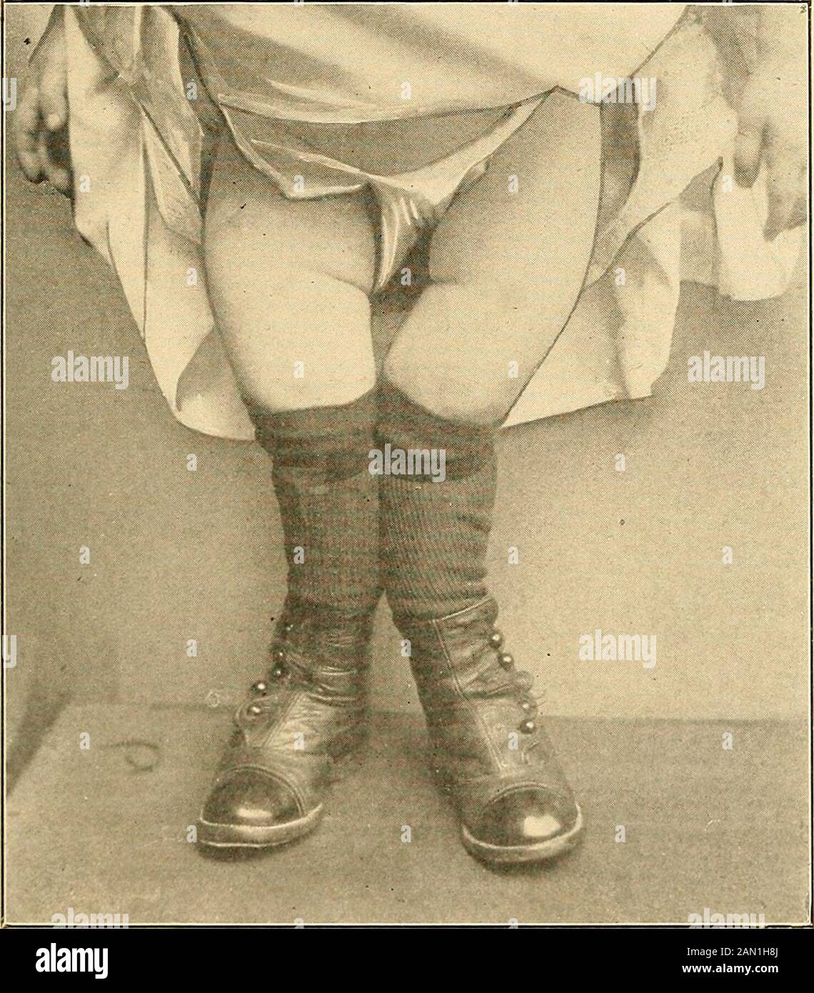Moderne Diagnose und Behandlung von Krankheiten der Kinder; eine Abhandlung über die medizinischen und chirurgischen Erkrankungen der Kindheit . Abb. 159-Rachitische Bow-legs, Kännförmige Abdo-men und Trennung von Epi-physem - Doppelgelenkung.(Sheffield.) RACHITIS. 501 Extremfälle, in denen das Wachstum in der Regel stark zurückgeschleudert wird, bestehen fort und erfordern gewaltsame Korrekturmaßnahmen. Die Muskeln nehmen in der Regel am rachitischen Prozess Teil.Sie sind dünn und flabby und teilweise verantwortlich für das schwierige Sitzen und gehen (Pseudoparalyse), die Bauchdistenthaltung Sraiysk (Topfbauch) und für die Con Stockfoto