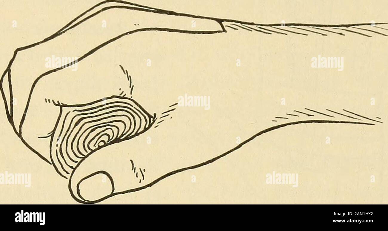 Der Hausmediziner, eine beliebte Arbeit zur Behandlung von Krankheiten, hat aufgehört, prominent zu sein und ist bis auf den Stand seiner Fellows gesunken. Das Ende des Fragments, das näher an der Armbanduhr liegt, ist im Allgemeinen in der Handrückseite oben vorprojiziert, während das Ende des unteren Fragments manchmal in der Handfläche zu spüren ist. Behandlung.-Wenn der Finger, der dem gebrochenen Knochen im Handrücken entspricht, gewaltsam weitergezogen wird und die zwischen Daumen und Zeigefinger der anderen Hand des Operators gehaltenen Bruchstücke, können Schmerzen und abnorme Bewegungen gut erkannt werden, und die Enden des gebrochenen Knochens sind möglicherweise präse Stockfoto