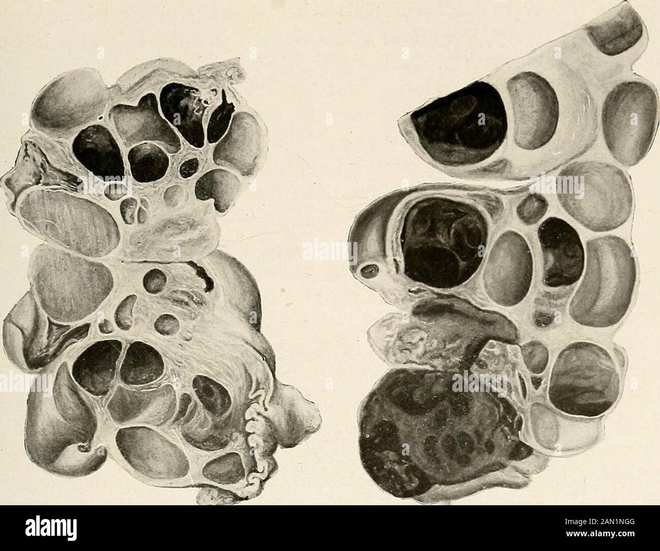 Gynäkologie für Studenten und Praktiker . Abb. 360. Mikroskopische Sektion des Normalen Corpus Luteum, wie sie in Den Platten III und V zu sehen ist. Die großen, an Zytoplasma reichen, monopnuklearen Lutein-Zellen bilden die gelben Konvolutionen. Entzündung DES EIERSTOCKS 655 mit Chorionepitheliom. Die durchschnittliche Größe solcher Zysten ist das. Abb. 361. Bilaterale Verbindung Theca-luteik Zysten aus einem Fall von Vesicijlar Mole, gefolgt von Chorionepitheliom. Eines fötalen Schädels. Im Allgemeinen eine zusammengesetzte Theca-lutein-Zyste Stockfoto