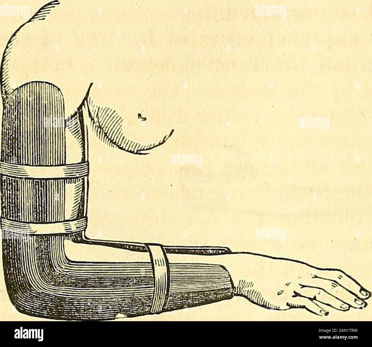 Ein chirurgisches System: Pathologisch, diagnostisch, therapeutisch und operativ. Oint; Umstände, die so manybehindiments für die Bildung von Osseusmata sind. Bei jungen Probanden und einer unangemessenen Behandlung kann eine Heilung in vier oder fünf Wochen gesucht werden. Die Behandlung ist ganz einfach, mit Blick auf die Durchblutungsrelaxation der Flexormuskeln des Ohrhörnchen. Zu diesem Zweck wird der Unterarm, nachdem er ordnungsgemäß mit den Fingern bis zum Ellenbogen verbunden wurde, und der Unterarm von der Schulter nach unten in die entgegengesetzte Richtung in einem rechten Winkel platziert, wie in Abb. zu sehen. 396 Stockfoto