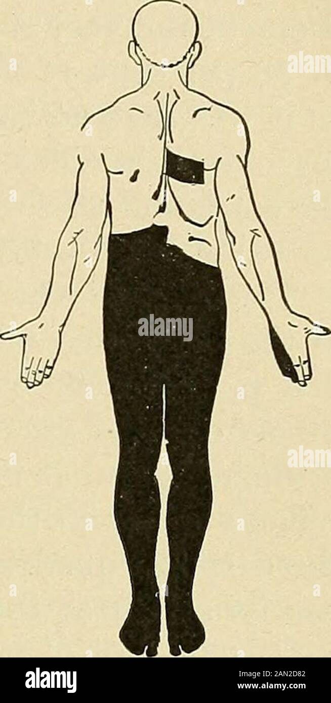 Organische und funktionelle Nervenkrankheiten; ein Textbuch der Neurologie . l Anzeichen der Erkrankung im Frühstadium sind der Verlust des Patellar-Sehnenreflex, der Verlust des Pupillenreflex an Licht und eine Verminderung der Pupille. Der Verlust Von Kniestrümpfen ist das frühste Symptom der Bewegungsapparat Ataxie und kann zu einer Angst vor dem Auftreten dieser Krankheit führen, selbst wenn Nasymptome vorhanden sind. Das gilt vor allem für Ärzte. Es ist daran zu erinnern, dass bei einigen normalen Personen der Knieherk nicht entwichen werden kann (2 Prozent.?). Es ist auch daran zu erinnern, dass bei den Bedingungen nach der Vorfebrile, notisch Stockfoto
