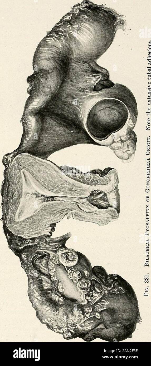 Gynäkologie für Studenten und Praktiker . Ion untergeht nicht bald, der Mund von Thetube wird geschlossen, Eiter sammelt sich im Lumen und die muskulösen und subserösen Schichten, Die bereits durch Ödem aufgeweicht und geschwollen sind, ergeben sich dem Druck durch das enthaltene Purulentensekret; so wird die Röhrenwand gespannt und relativ ausgedünnt, Butnie in gleichem Maße wie bei Hydrosalpinx. Das Endergebnis ist isa Pyosaljpinx. Andererseits kann dem initialen entzündlichen attackackapsis ein Rückfall oder wiederholte Rezidiven von subakuteund chronischen Entzündungen folgen. Statt eines PU Stockfoto
