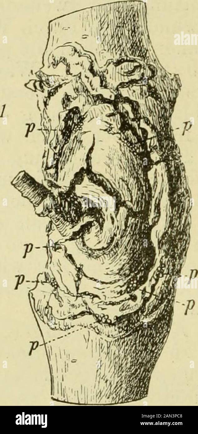 Handbuch der Flanzenkrankheiten . de, ist auch, wie ) Handbuch, 2. Aufl., II, 406. *) Deutsche Landw.-Gesellsch., 5. Lehrgang, zu Eisenach, 1904/05, S. 147. Sorauer, Handbuch. 3. Aufl. Z wir i t er baml. 14 210 III C. Ascomycetes. Schon Haktig annalim, ein echter Wundparasit. So übertrug R. Aderhold^die Konidien in drei bis fünf Millimeter lange Schnitte, die durch einen Skalpell in der Rinde von Apfel-, Pflaumen-, Birnen- und Kirschbäumenbracht die Waren und erzielte durch den nekrotischen Herde mitÜberwallungsrändern. Descouks-Desacres^) beobachtete, dafs die Nectriazu den von der Blutlaus ve Stockfoto