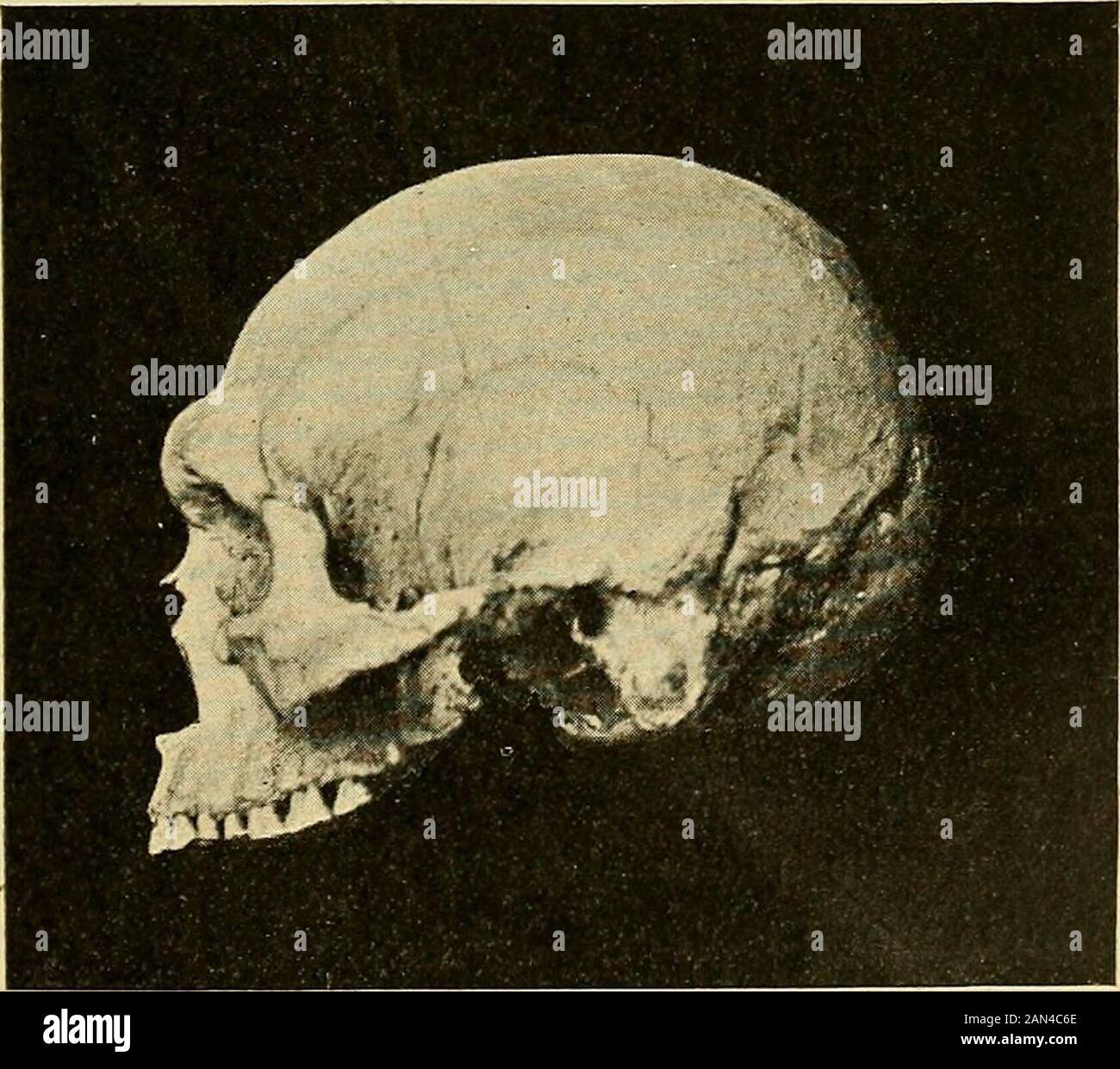 Trattato delle malattie mentali. Abb. 37. - Cranio peruviani con deformazione artificiale (per fasciature) di tipo Ayraarà: Nellarazza Aymarà (che lasciò traccio di alta civiltà) queste deformazioni erano generali e si riscon-trano di regola in tutti i crani (Museo Antropologico di Firenze). Abb. 38.-Cranio di tipo inferiore, raccolto nella Terra del Fuoco, con ampi seni frontali, forti ar-cate sopracigliari, prognostizsmo e straordinario rilievo di tutte le creste ossee che servono allin-serzione di muscoli dal Museo Antropologico di reneso) Stockfoto
