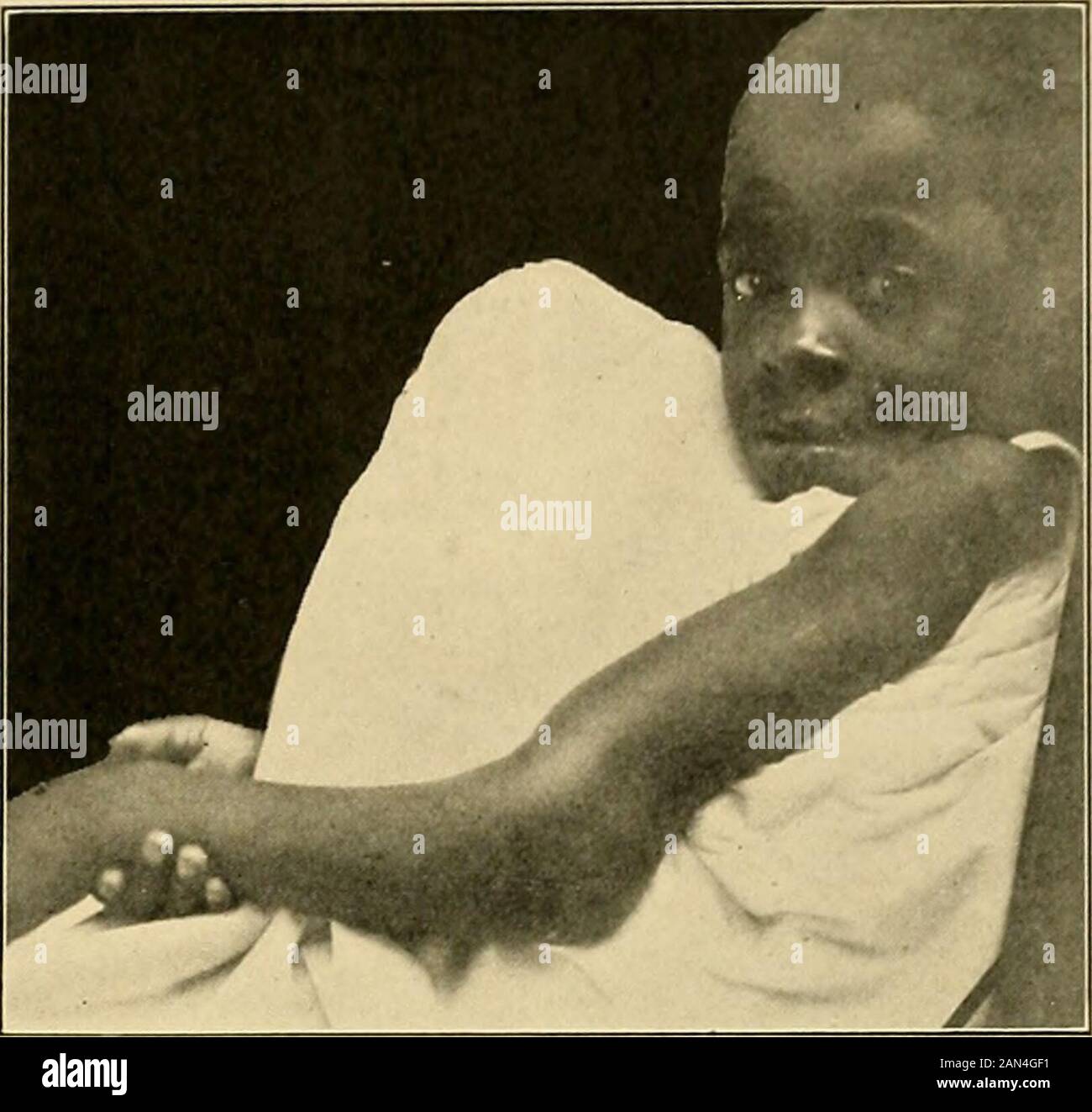 Die Behandlung von Frakturen . &lt;^EIN externes Condyle. I -- i Capitellum. - J obere radiale Epiphyse. Abb. 202.-Fraktur des äußeren Kondyles des Humerus. Kind im Alter von fünf Jahren. Nucleus forkapitellum unten gesehen Fragment. Epiphyse. Vor dem Ellenbogengelenk wird eine Fülle bemerkt, und im Nachhinein erscheint der Punkt des Ellenbogens prominent. Das kleine untere Fragment wird mit den Knochen des Unterarms nach hinten verschoben; das obere Fragment oder der Schaft des Thehumerus wird nach vorne verschoben, was die Fülle in der Biegung des Ellenbogens verursacht (siehe Abb. 205). Die drei knöchernen Punkte halten dienormale Stockfoto