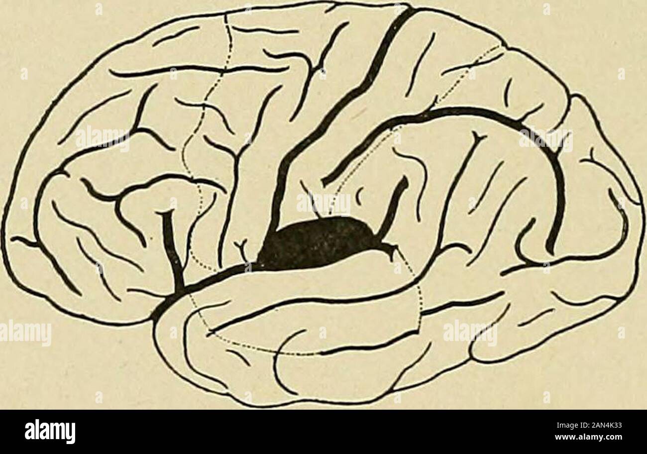 Organische und funktionelle Nervenkrankheiten; ein Textbuch der Neurologie . erformiert. So können Corticalbewegungen durch elektrische Anwendungen durch needlesto den Cortex gestartet werden, und bei chirurgischen Operationen für Jacksonian Epilepsie ist es gut, den Cortex mit einem faradischen Strom zu untersuchen, um Bewegungselemente zu entlocken, bis solche entstehen, die genau dem Spasmus der Unbehagen ähneln. Und dann, um den Bereich zu extirpieren, dessen genaue Funktion so estab-laished ist. Die lokalisierten Spasmen kortikaler Erkrankungen werden selten, wenn überhaupt, erfolgreich durch Malingerinnen oder Hysteriker imitiert. Manchmal kommt es zu einem Hemispasmus Stockfoto