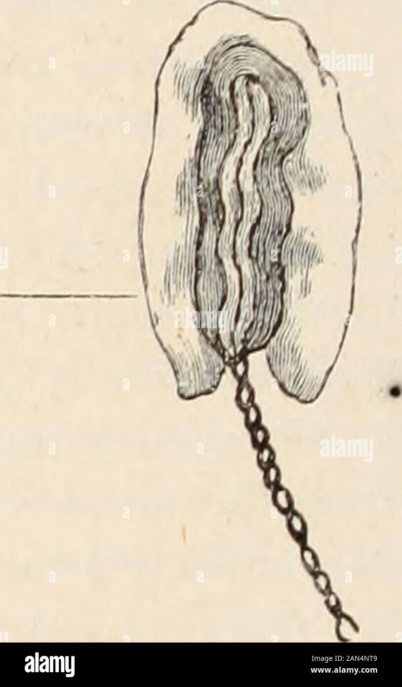 American Medical digest. . Abb. 2. So gemeinsam erarbeitet und in apposi gehalten, in genau der gleichen Weise wie apurse ist gezeichnet von den Geldbeutel string (seefig. 3, B). Wenn die Fistel ungewöhnlich groß ist, someslight Abweichung von dieser Methode wouldbe verfolgt. Es war mir ein Vergnügen, wit-ness Herr Tait führen Sie die operationwhen nur eine Naht notwendig war, und wie ich zu einem späteren Zeitpunkt verstanden, theresult war vollkommen zufriedenstellend. In der Nabelschnur und ventral hernia Operation in einer sehr similarmanner durchgeführt wird, werden die gleichen Grundsätze in - beteiligt. Natürlich mit den verschiedenen tissueswhich Dar t Stockfoto