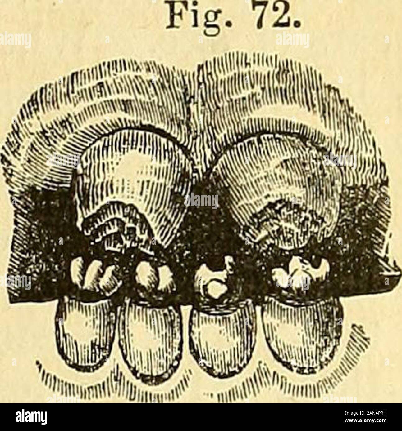 Ein System der Chirurgie: Pathologische, diagnostischen, therapeutischen und operativen. Syphilitische temporäre Zähne. Syphilitische pernuiueut Zähne. Anders als in der gut gefüttert und in der Halb verhungert. Iritis erscheint selten Bevorder fünften Monat, und ist in der Regel mit einer reichlichen Erguss der Lymphe besucht, mit großer Gefahr der Okklusion des Schülers. Corneitis ist am häufigsten vom achten bis zum 15. Jahr und ist fast immer mit einem dwarfedand verbundenen eingekerbte Zustand der ständigen zentralen Schneidezähnen des Oberkiefers. Gibt es in der Regel zu deutlichen Trübung der Hornhaut. - Die Behandlung. Stockfoto