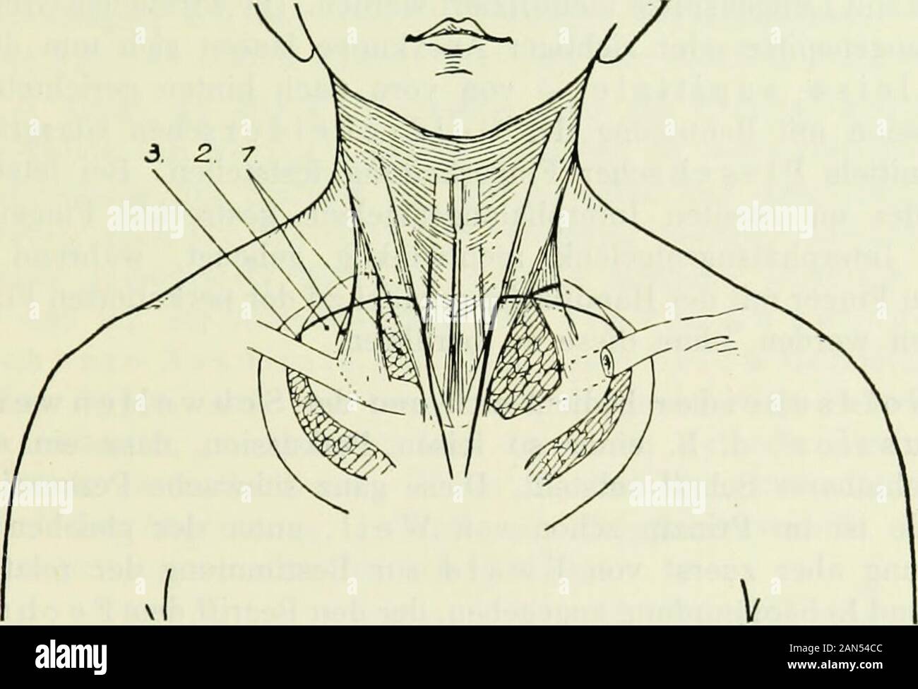 Die Klinik der Tuberkulose: Handbuch der gesamten Tuberkulose für Ärzte und Studierende. Milzdämpfung * - Untere Lungengrenzeb. tiefster Inspiration Traube scher halbmond-förmiger Raum Figur 1 und2 / Krön ig, Deutsche Klinik, Bd. 1, Bl. 11. Der lungenspitze nach oben und projiziert durch leiseste vonmedial / seitliche ausgeführte Perkussion vorn und hinten den vonder Lungenspitze ausgehenden Schall durch seitliche Begrenz- Zweites Kapitel. Der Ausfallschritt Tuberkulose sterben. 57 Ungslinien als breites Band über den Schultergürtel. Währendbei Lungenspitzen gesunden beide Schallfelder in gleicher Breite Stockfoto