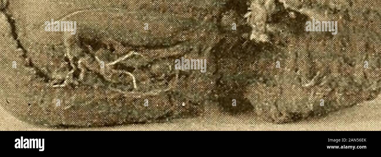 Gehirnchirurgie. Abb. 5 S.-Foto von einem Sarkom aus der Frontallappen entfernt. Fall XXI. Die Maßnahme über dem Tumor in Zentimeter aufgeteilt ist. wurde einheitlich in der Farbe dunkel und sehr Gefäßdiagnostik. Bei der ersten Inspektion der Oberfläche schien zu sein, dass eines überlasteten ordentlichen kortikalen Substanz. Es wurde jedoch in Konsistenz härter als normal war, und eine gute - sizedsection wurde mit dem Messer entfernt, und es war dann clearthat die ganze Gegend ausgesetzt war Tumorgewebe. Bei theend der Abschnitt entfernt einen deutlichen Kapsel wurde metwith, und nach dieser mit Finger- und stumpfen Schere, itwas nicht Diff Stockfoto