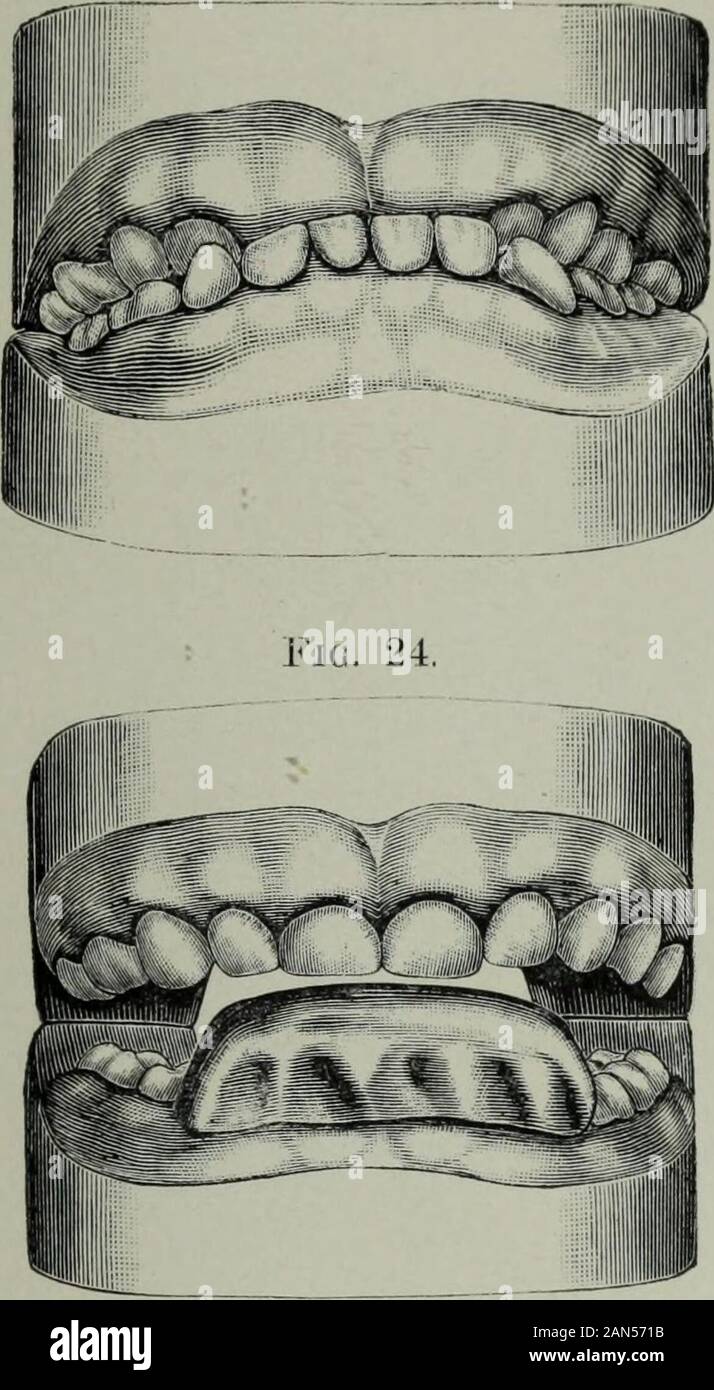 Die Zahnmedizinische Kosmos. Frau M., 36 Jahre alt. Anappliance wurde in den unteren archto eingefügt der Biss öffnen und die schneidezähne im Bezirk bewegen, und ein anderer in die oberen Bogen eingefügt für die Bewegung der Schneidezähne andcanines nach außen. Ein ähnlicher Fall, dass von einem girlthirteen Jahre, illustriert ist inFigs. 21. und 22. Abschließend mein Papier, will ich kurz JACKSON. - 0 BT JIODO N T 1 A. 353 beschreiben einen interessanten Fall von progna - thism in einem Kind im Alter von zwei Jahren und tenmonths. (Abb. 23.) Der Unterkiefer war sehr Prom incut, theincisors und Fangzähne berühren das Zahnfleisch vor der Oberen, wenn in o Stockfoto