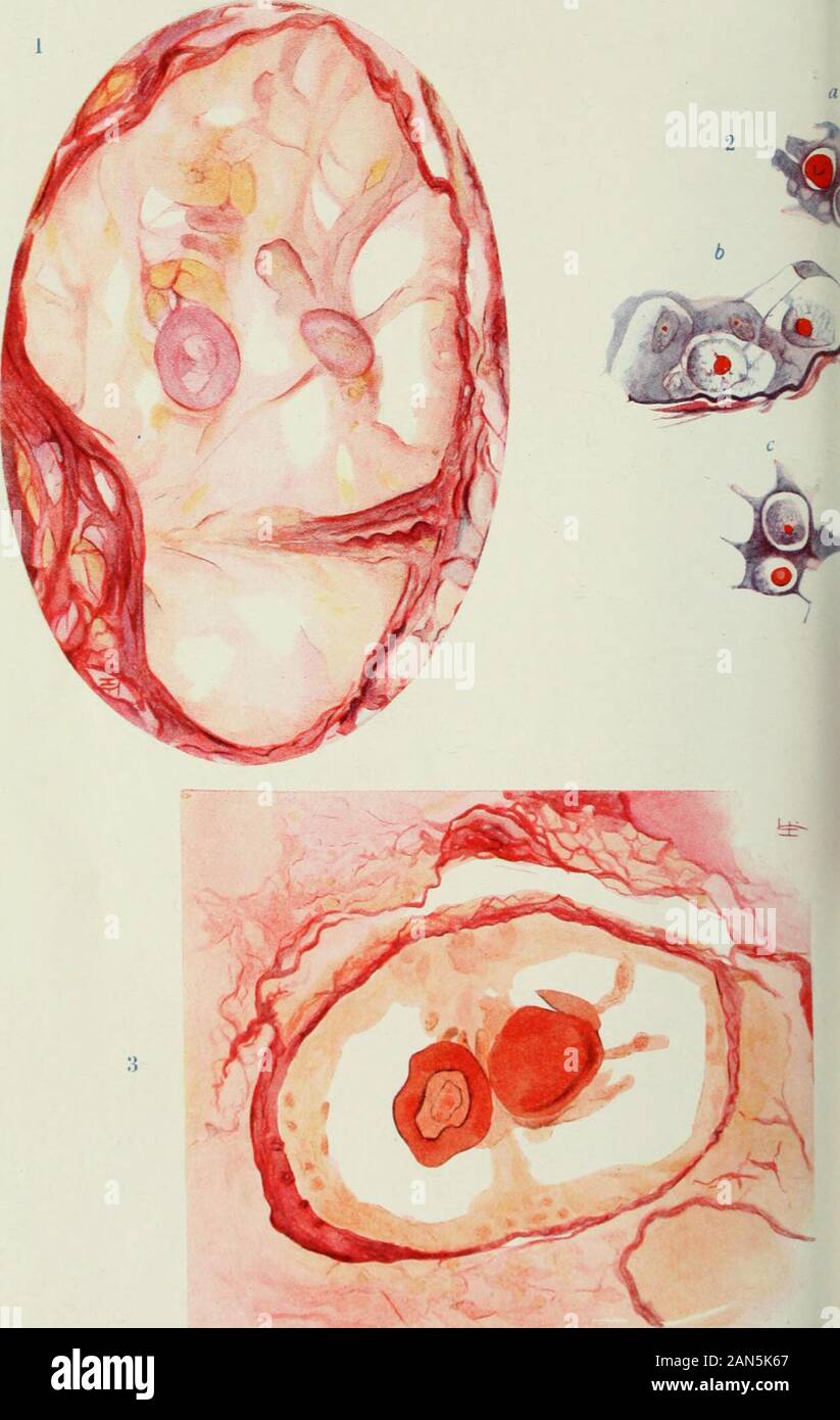 Vierteljährliche Zeitschrift für mikroskopische Wissenschaft. n characteristicof Kolloid. Eine Reihe von Kolloid Globuli sind in anderen Teilen des thelumen gesehen. Abb. 2.-Kat. Spermatozyten innerhalb der Tubuli seminiferi contorti. x 900. gebeizt Mallory. Zeigt jede Stufe in der Ausbildung der Kolloid globulesby Hypertrophie der Nukleolus. In (a) und (c) die Zellen sind centrallysituated, (b) Sie sind periphere. Abb. 3.- Kaninchen. Tubuli seminiferi Tubulus, x470. Gebeizt Van Gieson. Zwei ovum Körper vorhanden sind durch desquamated Zellen umgeben. Theyshow die Vivid orange Einfärbung Charakteristisch für Kolloid. Calcificationhas noch nicht s Stockfoto