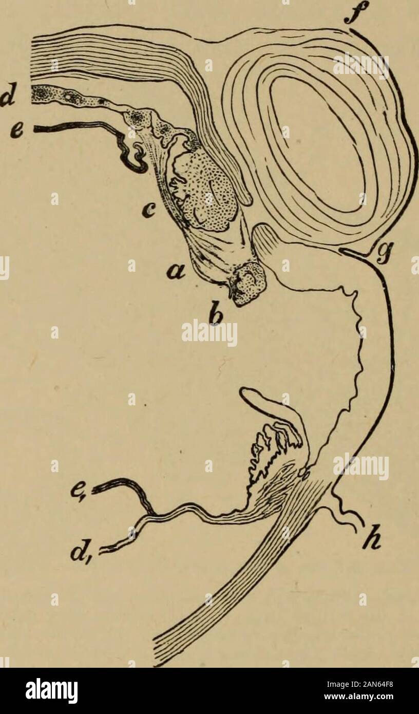 Lehrbuch der Augenheilkunde. cision der Iris. Vergrößerte 2 X 1. Die kurzen rupturewhich liegt in den Limbus hat nun sichtbar geworden, ein a, die Winkel der Schließmuskel, die nowproperly platziert sind. Manchmal sehr kleine Brüche auftreten, rechts in den Limbus selbst oder auch in der trans-parent Hornhaut (Abbn. 131, ac und ad). In diesen, aufgrund der engen Bindung von theconjunctiva, Letzteres ist unbedingt gebrochen und die iris fast immer Vorfälle. 344 Lehrbuch der Augenheilkunde Die Prognose dieser kleine Brüche ist gut, sofern die prolapsing Iris ausgeschnitten ist. Sie treten vergleichsweise Stockfoto