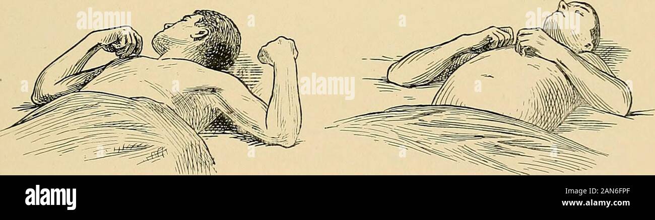 Die Behandlung von Frakturen. Abb. 80.- 6 Brustwirbel gebrochen. Anästhesie auf der Ebene der zwei Zoll über theumbilicus. Die achte oder neunte dorsale Nerv beteiligt.. Abb. 81.- Verletzung der Wirbelsäule zwischen fifthand sechsten Halswirbel. Hinweis positionder Waffen, durch Lähmung der subscapularis. Bizeps Positionen amicus, supinator longusand Oberarm Muskulatur intakt. Ellbogen gebeugt, Schultern entführt und nach außen gedreht (nach thorburn). Abb. 82.- Luxation des Sechsten und seventhcervical Wirbelkörper; typische Haltung; Mitte forsubscapularis nicht beteiligt (Kocher ändern). lendenwirbelsäule die Erweiterung beteiligt ist, t Stockfoto
