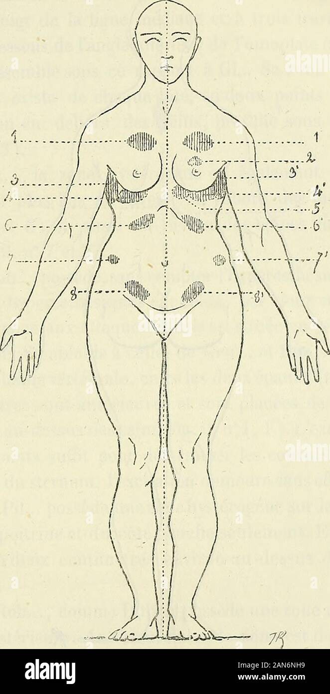 Études cliniques sur l'hystéro - épilepsie, ou Grande hystérie. ttaques Il semble quelexcitabilité soit épuisée, et la Pression de la Zone indiquée na-mène plus Aucun phénomène convulsif. Alph. B... Présente la même particularité. Elle raconte quaumoment où auf Lui touche Lépine dorsale Entre les Deux épaules, Elle ressent une douleur violente Dans le ventre, puis une suffoca -- qui amène de suite la Thermalkurort Bagnoles-de connaissance. Il semble quedans cette circonstance Les différents Points de laurahystérique douloureux, au lieu de se développer et successivement danslordre 1611, comme il lorsque ankommen Stockfoto