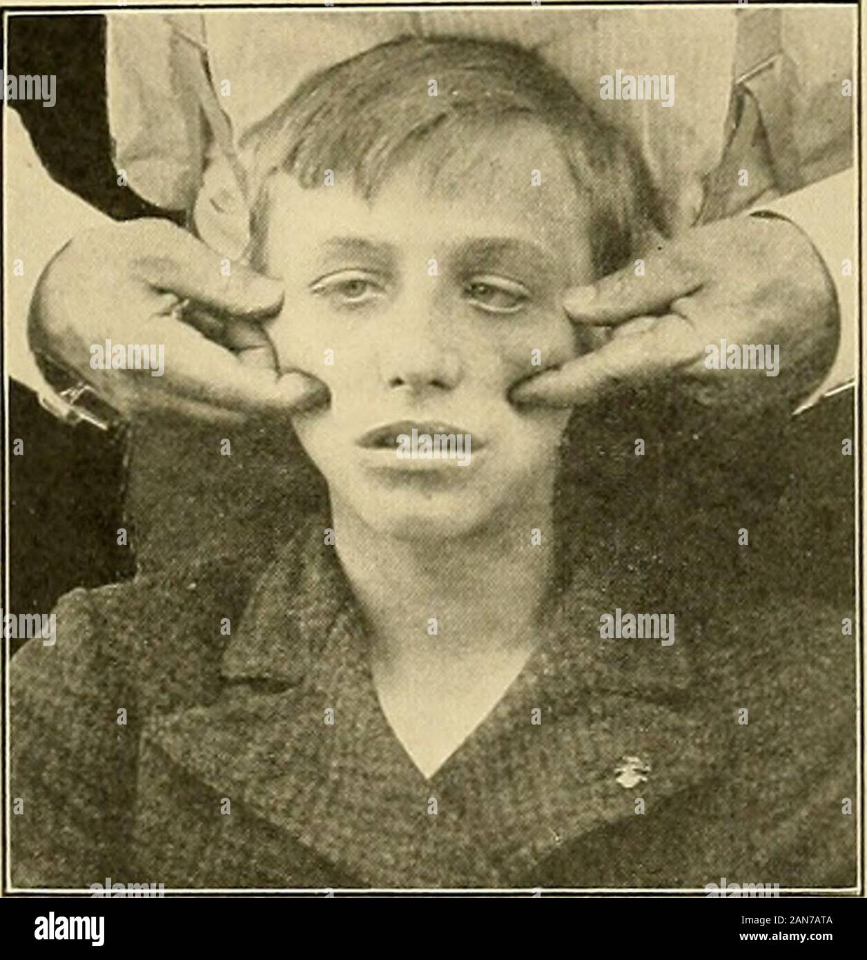 Die Behandlung von Frakturen. - Indem Sie die Haut der Check nach oben. Theorbital Teil dieses Prozesses liegt in der Mitte der FRAKTUREN DES MALAR KNOCHEN 53 Untere Grenze des Orbits zu spüren. Im Anschluss an die orbitale Marge heraus - in der Gemeinde und nach oben, die orbital Grenze ist Palpated bis zu den frontalprocess. Nach der malar Prozess der Superior maxillabackward, der Freien untere Grenze des malar ist continuousbackward mit dem jochbeinbogen Prozess fühlte. Beginnen Sie auf der frontalprocess, die posteriore Grenze des malar kann unten abgetastet werden, ward und rückwärts auf die obere Grenze der zy Stockfoto