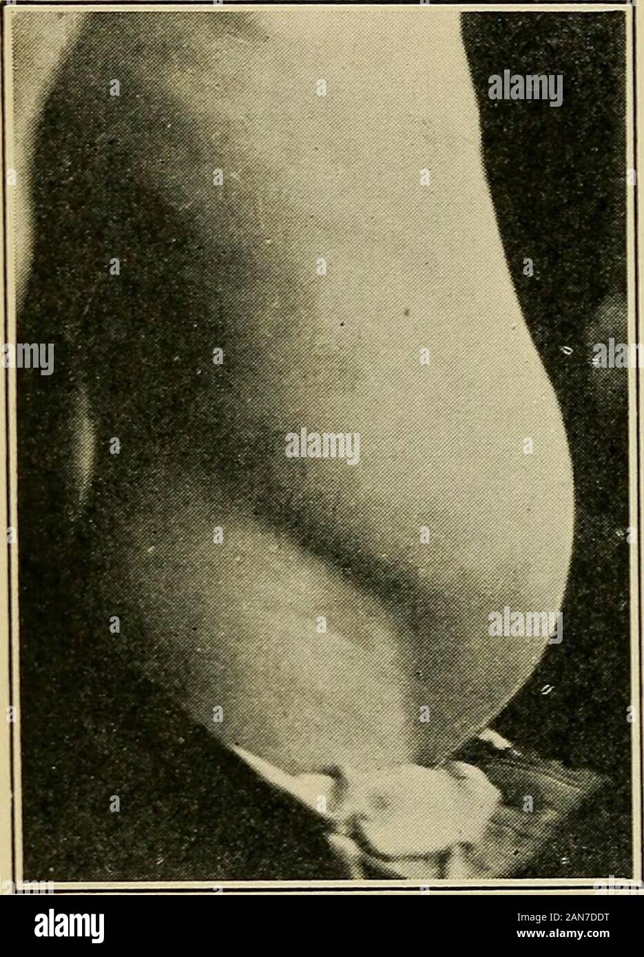 Rückeroberung der Krüppel; ein Handbuch der physikalischen Therapie. ariness, muss durch thismeans behandelt werden. Ein Soldat beginnt seinen Kopf rhythmisch tomove, seinen Arm, oder die Kupplung an der Klang einer Shell zucken, und theregimental Chirurg, wenn er iswise, schickt ihn wieder für eine Woche oder zwei Therest. Wenn er ist, bis die inevi-Tabelle smash kommt, seine Re-covery wird eine Frage ofmonths werden eingehalten, und er isusually aus commissionpermanently. Tremor coarseand Fein, bis zu dem Punkt, ofa Allgemeine konvulsive Anfälle, rhythmischen Bewegungen, wenn der Mensch ist, wenn er ist andcalming leftalone, sind charakteristisch. M gesprochen Stockfoto Rückeroberung der Krüppel; ein Handbuch der physikalischen Therapie. ariness, muss durch thismeans behandelt werden. Ein Soldat beginnt seinen Kopf rhythmisch tomove, seinen Arm, oder die Kupplung an der Klang einer Shell zucken, und theregimental Chirurg, wenn er iswise, schickt ihn wieder für eine Woche oder zwei Therest. Wenn er ist, bis die inevi-Tabelle smash kommt, seine Re-covery wird eine Frage ofmonths werden eingehalten, und er isusually aus commissionpermanently. Tremor coarseand Fein, bis zu dem Punkt, ofa Allgemeine konvulsive Anfälle, rhythmischen Bewegungen, wenn der Mensch ist, wenn er ist andcalming leftalone, sind charakteristisch. M gesprochen Stockfoto