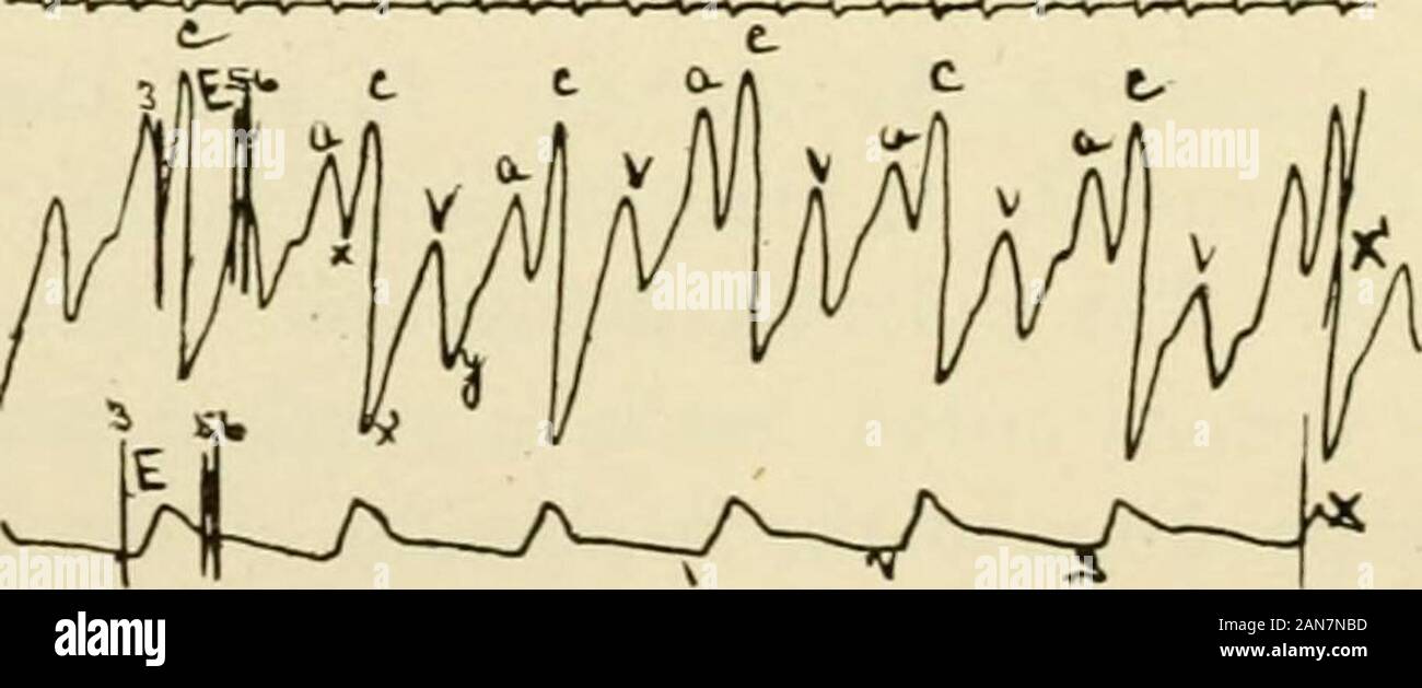 Physiologie und Biochemie in der modernen Medizin. Abb. 95.- Polysphygmograph. Dieses Instrument Datensätze in Tinte auf verglaste Papier zwei simul Taneous-Pausen, i.e., radial Pulse und eine andere, wie die A. carotis, Wespe, Apex Beat, etc., zusätzlich zu der Zeit aufspüren. Die Tinte nachzeichnung sind beide einfacher und dauerhafter als smokedpaper Pausen. Das Uhrwerk arbeitet mit variablen Geschwindigkeiten, Genehmigungsverfahren, der protractedrecords mit unterschiedlichen Geschwindigkeiten. Messen Sie den gleichen Abstand auf der venösen Tracing von c. Die Linie 5 wird gefunden, kurz bevor eine kleine Welle (v), der ope zu thesudden zu fallen Stockfoto