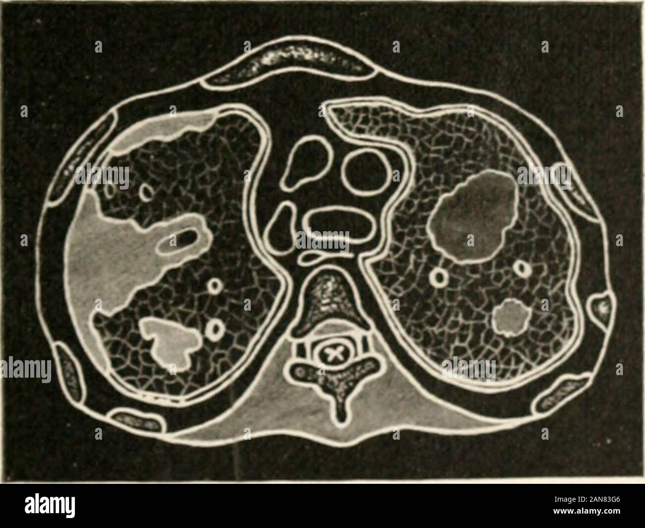 Die ärztliche Untersuchung über die Lebensversicherung und die damit verbundenen klinischen Methoden: mit Kapiteln über die Versicherung von minderwertigen Lebens- und Unfallversicherung. Bild ^s Emphysem. Die gebläht Luft-Zellen und voluminöse Lungen sind deutlich gezeigt. Abb. 59. M u kjnant 11 uid Pot m Die 1: Auf der linken Seite beinhaltet eine bronchien] Konsolidierung. Die anteriore oberflächlich? Hier pr "Zeichen gezeigt, und werden oft übersehen. 26 o DIE ÄRZTLICHE UNTERSUCHUNG ÜBER DIE LEBENSVERSICHERUNG. Die Brust im Querschnitt. - Ich fortgesetzt.) Stockfoto