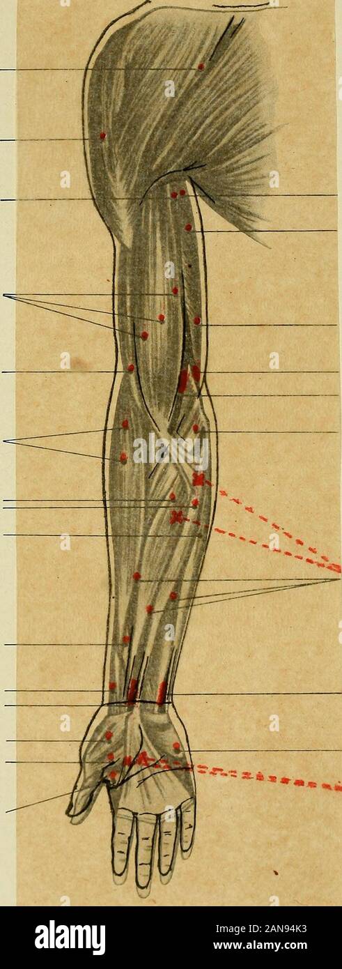 Leitfaden der Elektrodiagnostik und Elektrotherapie für Praktiker und Studierende. n kleinen Finger und abduziert ihn ein wenig. Sterben Daumenstrecker (Extensor pollicis Longus und Brevis) und der Abductor pollicis Longus, Erregbar nahe dem radialenRande der Streckseite, etwa vier Fingerbreiten über dem (d. h. proximalvom) Handgelenk (hier meistens der Abdiditor allein), sowie auch ein wenig distalund Ulnaren von dem genannten Punkte. This Muskeln, vondenen der Entführer der Extensor longus und Brevis sterben Sog. "Tabatiereradialwärts, der extensor Longus ulnarwärts begrenzen, bewegen denDaumen in fol Stockfoto