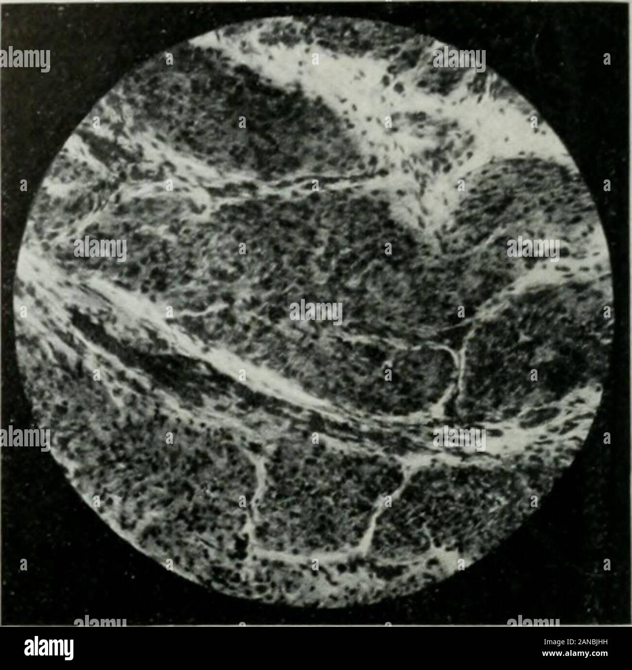 Das Journal der Labor- und klinische Medizin. Abb. 10.- (IA7 AZQ.) Mehrere primäre Tumoren, atypische Form von perniziöser Anämie, hohe cholesterinvalue im Blut (0,71%), bösartige prolifera-tion der Magenschleimhaut. (He x 250 Durchm.) Abb. 12.- (^ Sanie als Bild. 10.) Invasion der Dieäußeren muskulären Schichten. (He x 600 Durchm.) Stockfoto