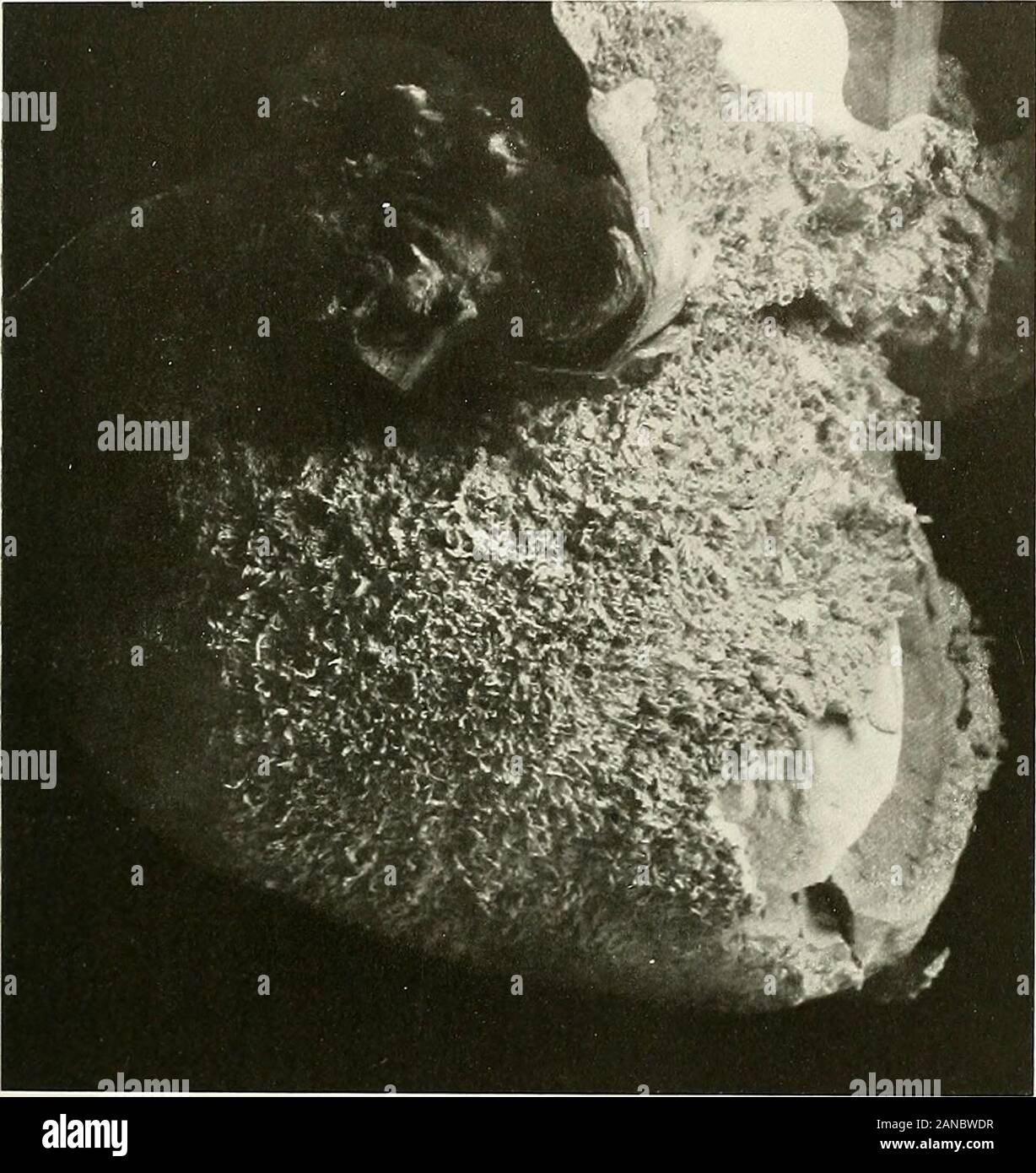 Studien der kardialen Pathologie. ) Thepericardial Obhteration der Hohlraum mit deutlichen Anstieg des Mediastinums Bindegewebe, withor ohne caseation, (b) Obliteration der Herzbeutel mit umfangreichen Ad-hesions zu den umgebenden Strukturen, ohne viel Anstieg der mediastinaltissue, (c) Mediastinitis ohne pericardial Beteiligung. Die wichtigsten Verwachsungen sind diejenigen, die auftreten, zwischen der äußeren Oberfläche des SAC und der umliegenden Strukturen, da es in diesen Fällen, dass das Herz ist der größte extenthampered und in ihrer Tätigkeit eingeschränkt. Wenn neben der pericardiu Stockfoto