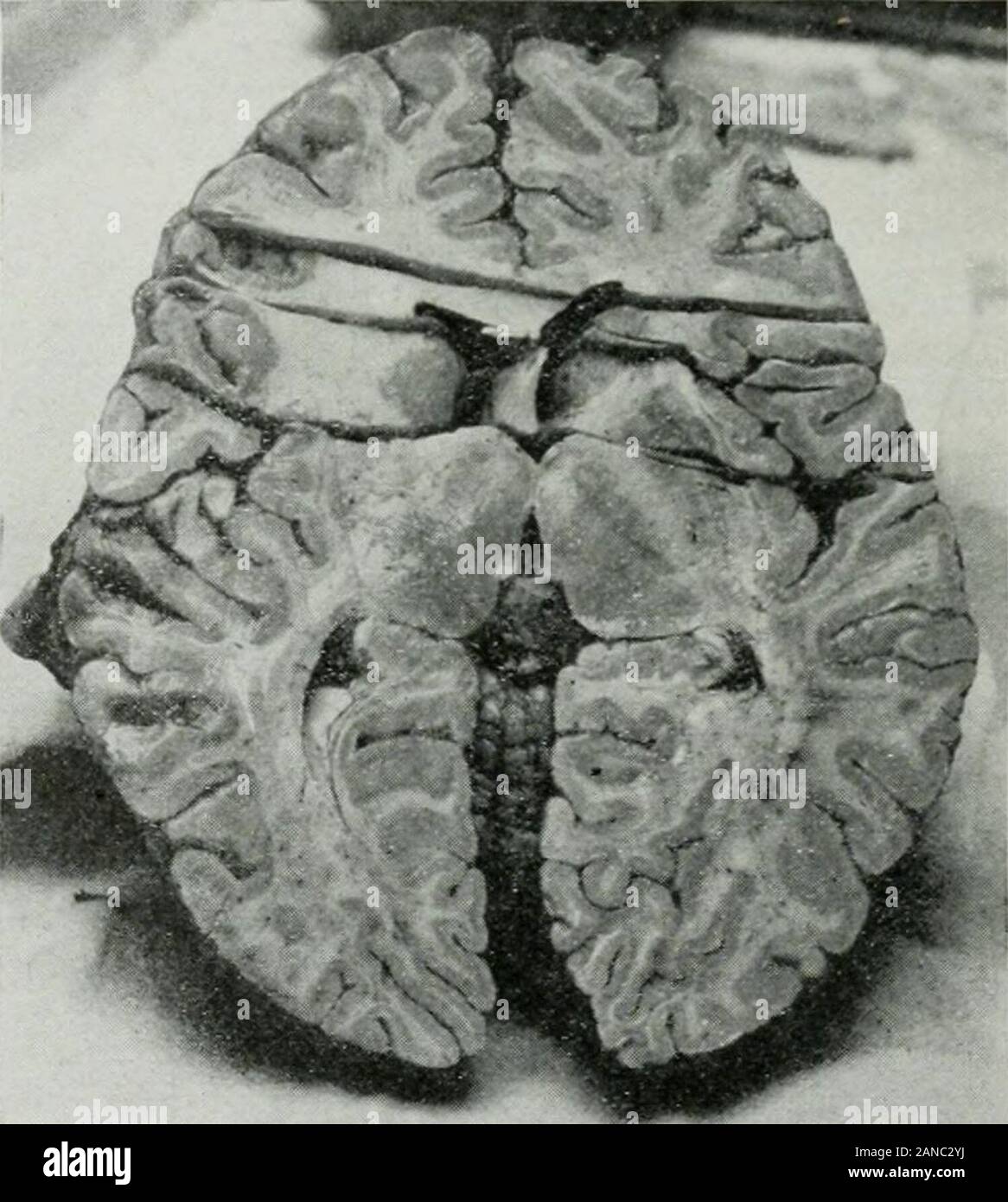 Das Journal der Labor- und klinische Medizin. ar Kern. Dieses kleine gebrochene stripwas sehr klein in der Stärke als auch in der Breite und etwa 1 cm in der Länge. Die caudate Kern sehr geschrumpft war, aber immer noch mit Theregion der lenticular Kern es gut konserviert wurde und dessen Fasern konnten beeasily Unterschieden verglichen. Einen Querschnitt in der Region des Corpus striatumof beider Hemisphären des Gehirns in den ersten cuttingalong entfernt die Marie line von Auswahl, zeigte sehr deutlich die geschrumpfte caudatenucleus und die dilatation des anterioren Horn von der linken v Stockfoto