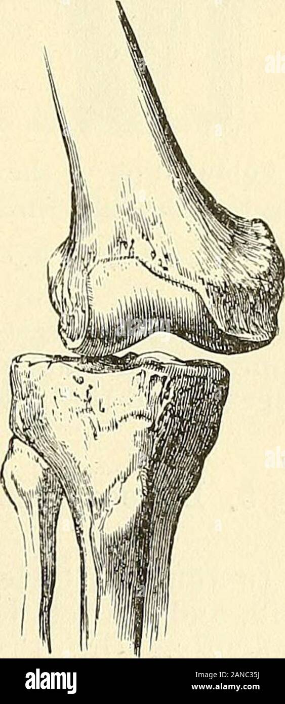 Eine praktische Abhandlung über Brüche und Verwerfungen. te Flexion und Extension, der Knochen war leicht andpromptly an seinen Platz wiederhergestellt. Sehr wenig Schwellung fol-folgten den Unfall und seine Erholung erfolgte schnell und kom- plette. Ein Mann in der North London Hospital empfangen wurde, mit einer teilweisen Verlagerung des Schienbeins nach außen, und althoughthe Knie wurde viel geschwollen, die Art der Schädigung waseasily bestimmt. Das Knie wurde unbeweglich, und thetoes nach aussen gedreht. Herr Hallam, das Haus Chirurg, reduziert es durch Verlängerung und Erweiterung withhis eigenen Hände. 1 Herr Pitt Datensätze in einem ähnlichen Fall in einem Youn Stockfoto