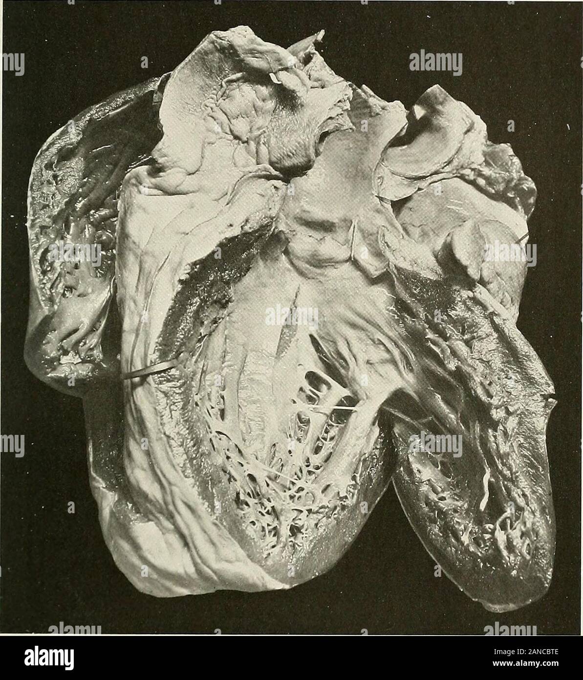 Studien der kardialen Pathologie. ged, enthält Huhn - fat Clot, und zeigt, wie stark der Messdraht col-umnae Verdiener. Rechtsventrikulären Wand, 4 mm. Auriculo-ventrikulärer Drossel Maßnahmen 15 cm.; zeigt Merkblätter die mässig entlang der freien Kante verdickt sind. Chordae tendineae Dick - ened und eingefahren. Pulmonale Öffnung 9 cm.; Zeigt allgemeine Verdickung der Ventile andsclerosis der Nasennebenhöhlen. Pulmonalis zeigt leichte Plakette - wie Sklerose. Endocardiumgenerally normal. Koronare mäßig sclerosed. (Für mehrere Jahre vor diesem Patienten Tod der Autor von Zeit zu Zeit opp hatte Stockfoto