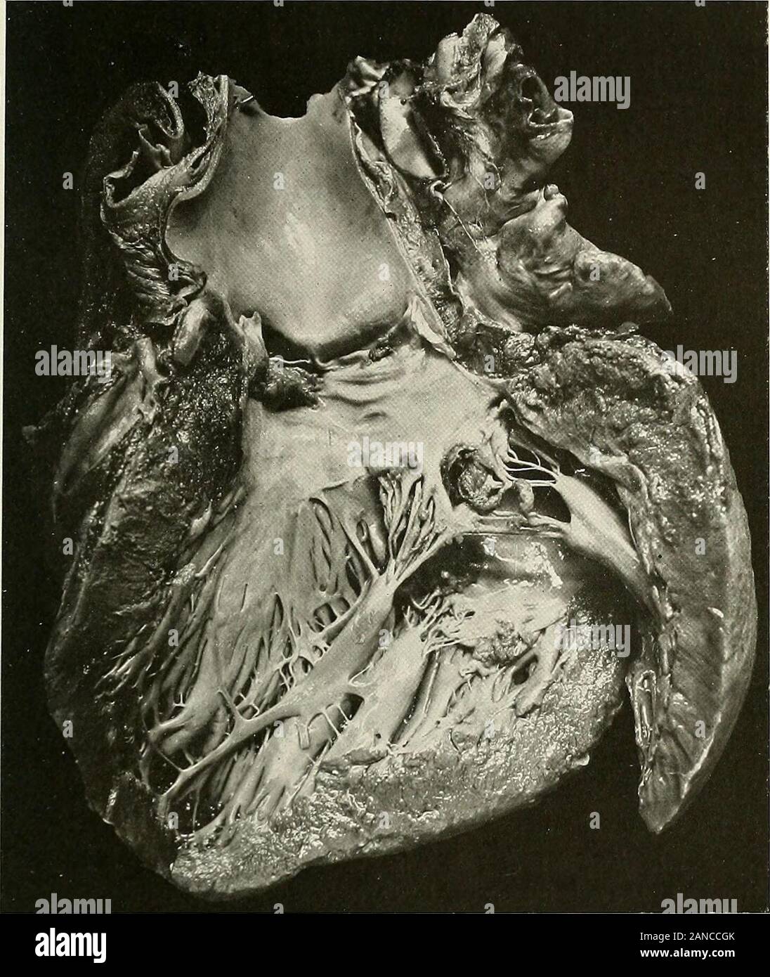 Studien der kardialen Pathologie. Murmeln isheard an der Spitze und an der  Axilla übertragen. Eine zweifelhafte systolisches Geräusch ist bei  theaortic Bereich gehört. Der zweite klingt an der Basis sind undeutlich.  Der