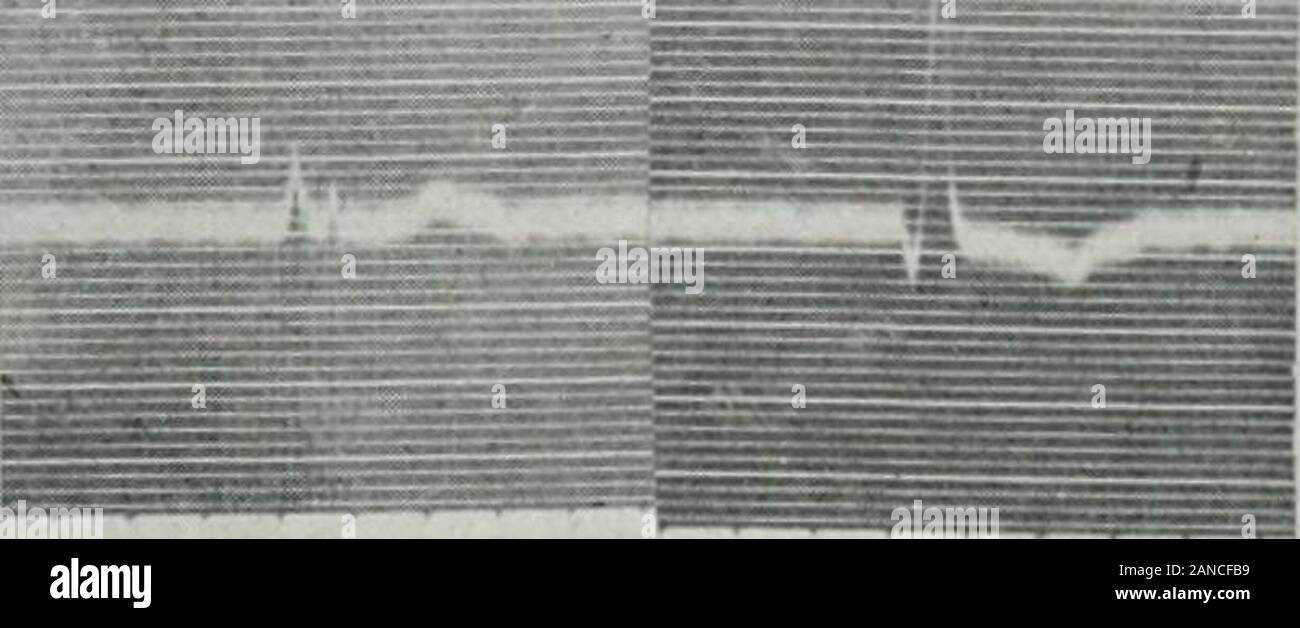 Das Journal der Labor- und klinische Medizin. Abb. 7.- Zwei verschiedene Arten von ventrikulären Komplexe, die von einem Fall von avnicnlar Lil&gt; rillationwith komplette Herz-Block. Die Art der ventrikulären Komplexe beschriftet Scries II war eine tlie usuallypresent. (Siehe Diskussion im Text.) Ves sind nicht normal und wie ca&gt; cs nuisl liegen von As-suming, dass das Controlling liegt unter dem von bifurcalion bundleor Llie sein, dass, wenn das Zentrum liegt oberhalb dieses jioinl Es ist ein Baustein in einem braiicli von theHis bundle erläutert. Noch seltener die Art der ventrikulären Komplex in komplette h Stockfoto
