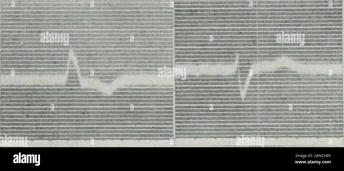Das Journal der Labor- und klinische Medizin. Zweige der sein Bündel gleichzeitig. Die Idioventricular Rhythm von kompletten Herz-Block. In der kompletten Herz - der Stimuli, die am Sinusknoten areprevented vom Erreichen der Herzkammern und die rhythmischen des ventricu - Regelmäßige Ektope Rhythmen 483 lar Zentren wirkt als Schrittmacher für diese Herzen Kammern gebildet werden. Die idioventricularrhythm in solchen Fällen ist ein langsames, normalerweise etwa 30 pro Minute. Die Rate ist in - durch Übung fluenced, nicht aber in der Regel von vagus Stimulation. Der Rhythmus isa homogenetic: ihr Versagen zu beeinflussen. Stockfoto
