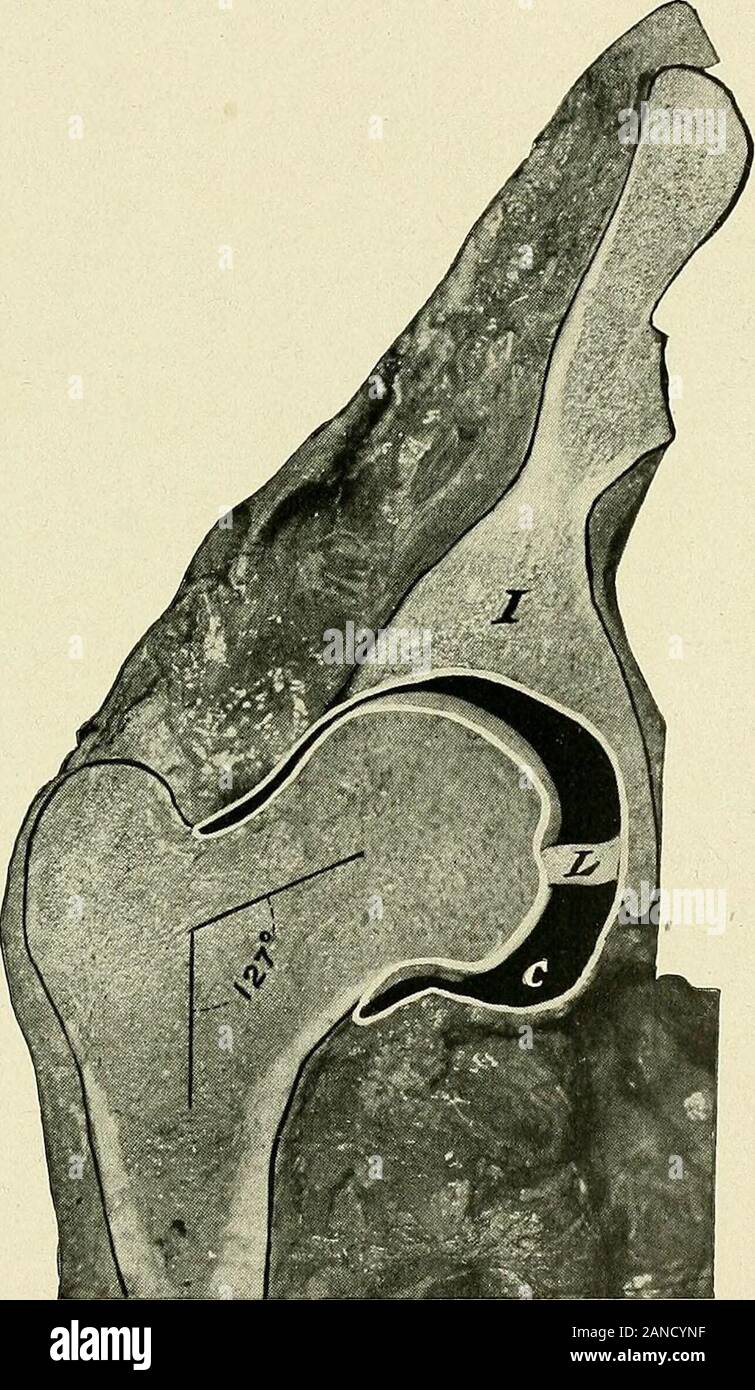 Ein text-Buch der klinischen Anatomie: für Studenten und Praktiker. ule, schieben orpulling der Kopf des Acetabulums. Angeborene Störung wird am häufigsten der hinteren Reihe (siehe Abb. 143). Es ist häufiger einseitigen, und tritt mehr frequentlyin Frauen (88 Prozent). Es ist Aufgrund der Kopf gezwungen, unterwegs das acetabulum in einem frühen Zeitraum der intrauterinen Leben, das resultof der verstärkten Anwendung der Uteruswand an der Hüfte, der aufgrund einer De- menge der Liquor amnii (hoffa). Das acetabulum becomesflatter (siehe Abb. 143) und die Kapsel wird in der Regel gestreckt Das zu inclose Stockfoto