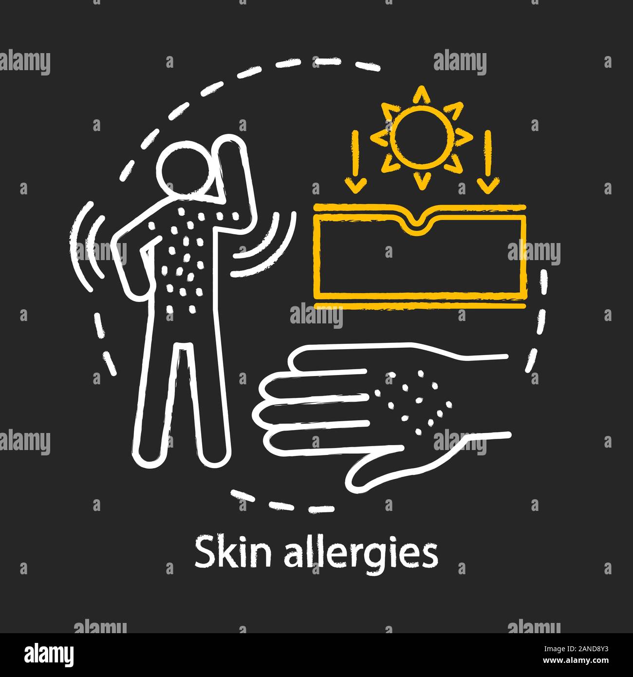 Hautallergien chalk Konzept Symbol. Hautausschlag, Kontaktdermatitis, Bienenstöcke Idee. Sonnenlicht, Lebensmittel, Medikamente, Insektenstichen allergische Reaktion. Vektor isoliert c Stock Vektor