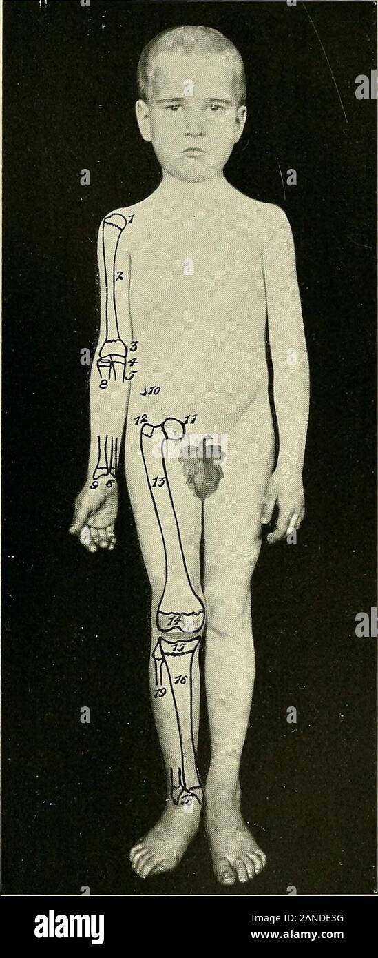 Ein text-Buch der klinischen Anatomie: für Studenten und Praktiker. Extern carpi Rad. brevior etRadialislongior Abb. 115.- Querschnitt nur über dem Handgelenk. 365. Abb. 116.- epiphysen in Jungen, im Alter von sechs. i, oberer Epiphyse des Humerus. 2, welledes Humerus. 3, Untere Epiphyse des Humerus. 4, obere Epiphyse Der ulna. 5, Welledes ulna. 6, Untere epiphyse der ulna. 8, Welle von Radius, vor der der obere epi-Physis. 9, Untere epiphyse von Radius. 10, anterior superior Wirbelsäule von Ilium. 11, Headof Femur, Anzeigen epiphyseal Line-Beitritt an den Hals. 12, größere trochanteric epi-Physis. 13, Welle des Femur. 14, Stockfoto