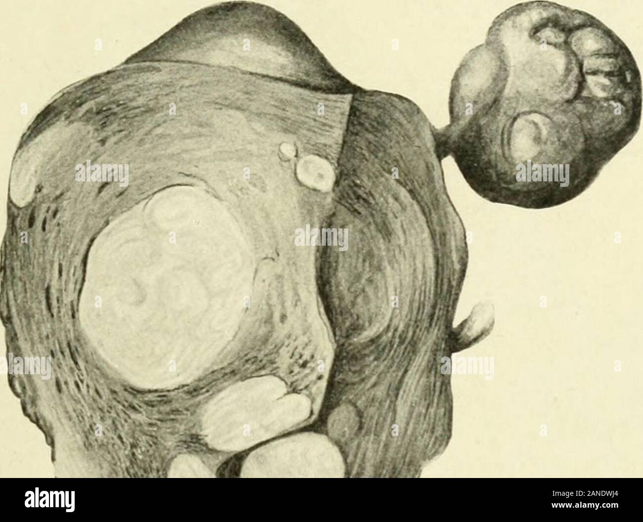 Myome und alliierten Tumoren (Myome und adenomyoma): ihre Pathologie, klinische Merkmale und chirurgische Behandlung. Zu FACK. Seite 97 KREBS DER KÖRPER 97 des Wachstum von Krebs - Zellen. Die Verbreitung von Krebs - Zellen nahm der Linie des geringsten Widerstandes, und lief entlang der. Stockfoto