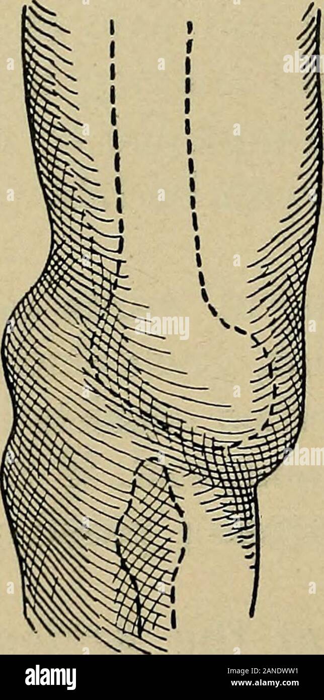 Atlas und Inbegriff von traumatischen Frakturen und Verrenkungen. Frakturen am Gelenkknorpel Ex-tremity. - dazu gehören die Trennung von dünnen Platten ofbone von der Rinde, entsprechend der Einfügungen seitlichen Bänder des, durch schwere Verdrehen der Gemeinsamen andsplit Frakturen Trennung Stücke aus der knorpeligen capof den Oberschenkelknochen. Sie sind reine Intra-artikuläre Verletzungen, und später diskutiert werden. 4. Knie = Gemeinsame (A) die Verschiebung des Kniegelenk intra-artikuläre Verletzungen der Bandapparat des Kniegelenk sind nicht so selten wie die wahre Verrenkungen 288 Frakturen und Verrenkungen. Der j Stockfoto