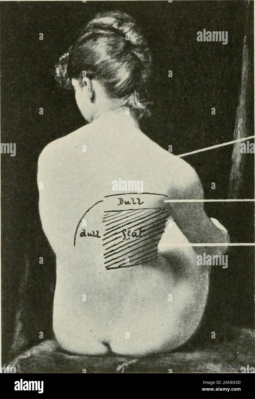 Erkrankungen der Brust und der Prinzipien der physischen Diagnose. achselhöhle oder anterior und