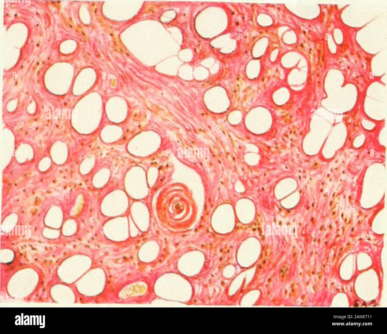 Myome und alliierten Tumoren (Myome und adenomyoma): ihre Pathologie, klinische Merkmale und chirurgische Behandlung. orm von großen fettkügelchen distends eachof, die eine Zelle. Diese Zellen sind in der: calciumfluoride Siegelringe, das Erscheinungsbild der Fettgewebe beingsimilar an das normale lipomatous Bindegewebe. Feines Granulat von Fett, wie die charakteristisch für fattydegeneration (siehe Abb. 70, Platte XIV.^), sind vorhanden neitherin der Muskel - noch im Bindegewebe - Gewebe, Zellen, noch ist thereevidence anderer Entartung der Zelle - Elementen. Es gibt daher keine Anhaltspunkte dafür, dass die lipomatoustissue Stockfoto