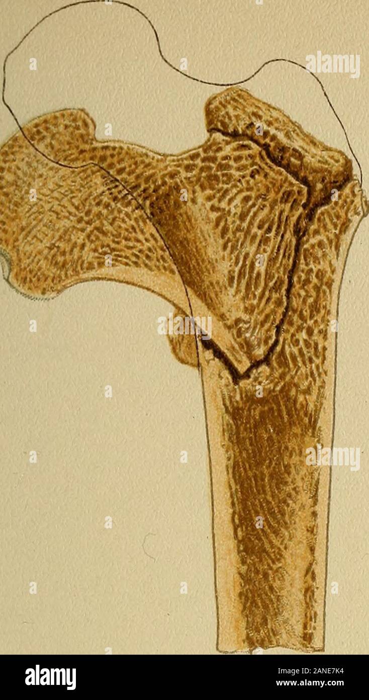 Atlas und Inbegriff von traumatischen Frakturen und Verrenkungen. lustrated in der platewas bei der Autopsie. (Autoren Sammlung.) Der Körper. Der Körper gegen den Boden, stonepavement, oder Holzböden markante führt zu einer Kompression Hals des Femur in seiner Längsachse ofthe, zwischen thehead und die trochanteric Region. Diese Komprimierung, als im analogen Fall von Gewalt angewandt auf die langen Knochen (am oberen Ende des Humerus), produziert eine Fraktur an Thepoint der Kreuzung zwischen der dünner kompakte Hals der thefemur und voluminöser und schwammige Gewebe von theadjacent Region. Bruch Stockfoto