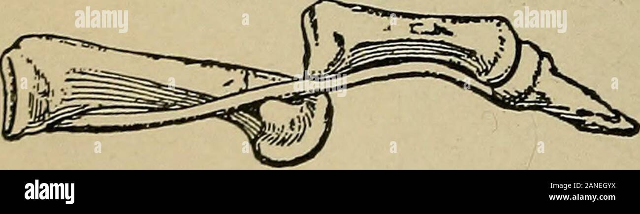 Atlas und Inbegriff von traumatischen Frakturen und Verrenkungen. Abb. 112.- Reduktion ist^ vonder Interposition des sesamoid Bone ented. lebendige Subjekt und auf thehad künstlich hergestellt worden, der Hals des firstmetacarpal Knochen; wenn thearticular Oberfläche von thecapitellum ist greatlythickened auf seinen ulnarside, wie manchmal Hap-Stifte, die Sehne maycatch auf dieser verdickte Rand und bilden ein unüberwindbares Hindernis für die Bedingung kann manchmal mit dem Daumen anerkannt werden, leicht gedreht in Richtung der andinclined ulnarside und die Sehne maysometimes, aber nicht durch anymeans immer disen werden Stockfoto